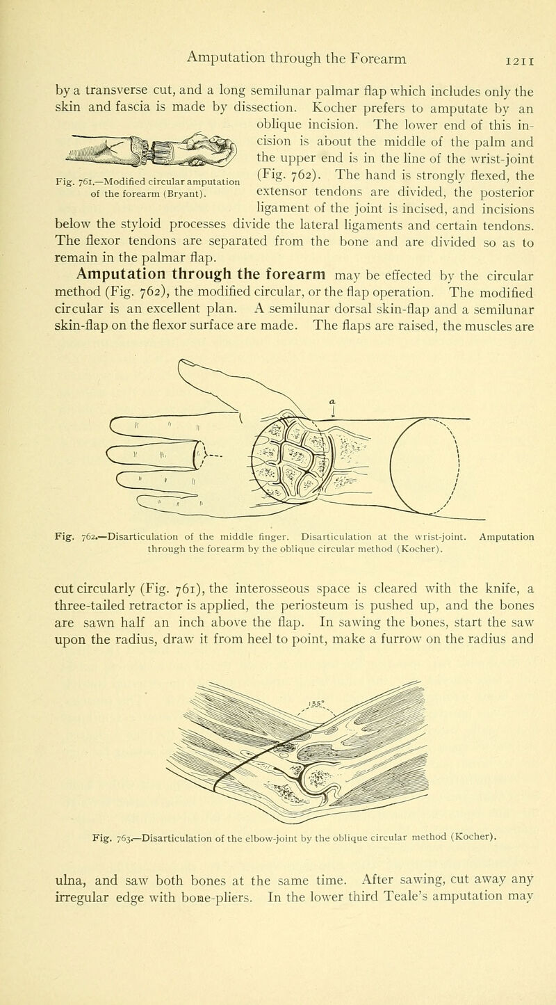 Fig. 761.—Modified circular amputation of the forearm (Bryant). by a transverse cut, and a long semilunar palmar flap which includes only the skin and fascia is made by dissection. Kocher prefers to amputate by an oblique incision. The lower end of this in- cision is about the middle of the palm and the upper end is in the line of the wrist-joint (Fig. 762). The hand is strongly flexed, the extensor tendons are divided, the posterior ligament of the joint is incised, and incisions below the styloid processes divide the lateral ligaments and certain tendons. The flexor tendons are separated from the bone and are divided so as to remain in the palmar flap. Amputation through the forearm may be effected by the circular method (Fig. 762), the modified circular, or the flap operation. The modified circular is an excellent plan. A semilunar dorsal skin-flap and a semilunar skin-flap on the flexor surface are made. The flaps are raised, the muscles are Fig. 762.—Disarticulation of the middle finger. Disarticulation at the wrist-joint, through the forearm by the oblique circular method (Kocher). Amputation cut circularly (Fig. 761), the interosseous space is cleared with the knife, a three-tailed retractor is applied, the periosteum is pushed up, and the bones are sawn half an inch above the flap. In sawing the bones, start the saw upon the radius, draw it from heel to point, make a furrow on the radius and Fig. 763.—Disarticulation of the elbow-joint by the oblique circular method (Kocher). ulna, and saw both bones at the same time. After sawing, cut away any irregular edge with bone-pliers. In the lower third Teale's amputation may