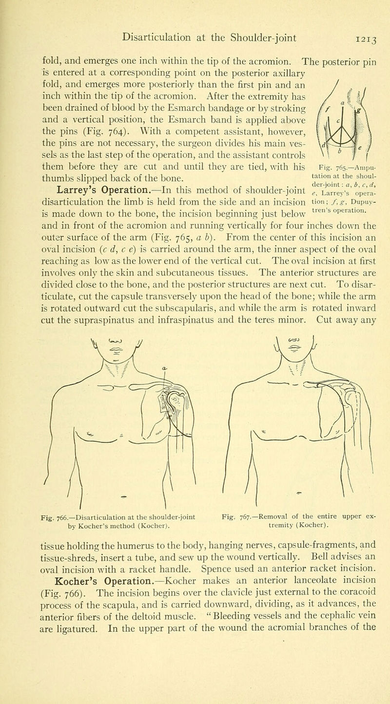 Disarticulation at tiie Shoulder-joint fold, and emerges one inch within the tip of the acromion. The posterior pin is entered at a corresponding point on the posterior axillary fold, and emerges more posteriorly than the first pin and an inch within the tip of the acromion. After the extremity has been drained of blood by the Esmarch bandage or by stroking and a vertical position, the Esmarch band is applied above the pins (Fig. 764). With a competent assistant, however, the pins are not necessary, the surgeon divides his main ves- sels as the last step of the operation, and the assistant controls them before they are cut and until they are tied, with his thumbs slipped back of the bone. Larrey's Operation.—In this method of shoulder-joint disarticulation the Hmb is held from the side and an incision is made down to the bone, the incision beginning just below and in front of the acromion and running vertically for four inches down the outer surface of the arm (Fig. 765, a b). From the center of this incision an oval incision {c d, c e) is carried around the arm, the inner aspect of the oval reaching as low as the lower end of the vertical cut. The oval incision at first involves only the skin and subcutaneous tissues. The anterior structures are divided close to the bone, and the posterior structures are next cut. To disar- ticulate, cut the capsule transversely upon the head of the bone; while the arm is rotated outward cut the subscapularis, and while the arm is rotated inward cut the supraspinatus and infraspinatus and the teres minor. Cut away any Fig. 765.—Ampu- tation at the shoul- der-joint : a, b, c,d, e, Larrey's opera- tion ; y, g, Dupuy- tren's operation. Fig. 766.—Disarticulation at the shoulder-joint by Kocher's method (Kocher). Fig. 767.—Removal of the entire upper ex- tremity (Kocher). tissue holding the humerus to the body, hanging nerves, capsule-fragments, and tissue-shreds, insert a tube, and sew up the wound vertically. Bell advises an oval incision with a racket handle. Spence used an anterior racket incision. Kocher's Operation.—Kocher makes an anterior lanceolate incision (Fig. 766). The incision begins over the clavicle just external to the coracoid process of the scapula, and is carried downward, dividing, as it advances, the anterior fibers of the deltoid muscle. Bleeding vessels and the cephalic vein are ligatured. In the upper part of the wound the acromial branches of the