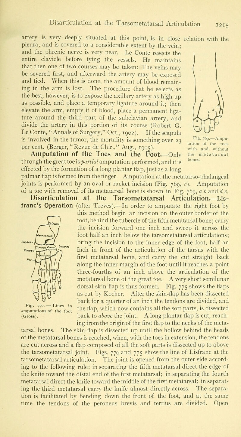 Fig. 769.—Ampu- tation of the toes with and without the metatarsal bones. artery is very deeply situated at this point, is in close relation with the pleura, and is covered to a considerable extent by the vein; and the phrenic nerve is very near. Le Conte resects the entire clavicle before tying the vessels. He maintains that then one of two courses may be taken: The veins may be severed first, and afterward the artery may be exposed and tied. \\'hen this is done, the amount of blood remain- ing in the arm is lost. The procedure that he selects as the best, however, is to expose the axillary artery as high up as possible, and place a temporary ligature around it; then elevate the arm, empty it of blood, place a permanent liga- ture around the third part of the subclavian artery, and divide the artery in this portion of its course (Robert G. Le Conte,  Annals of Surgery, Oct., 1902). If the scapula is involved in the tumor, the mortality is something over 23 percent. (Berger, Revue de Chir., Aug., 1905). Amputation of the Toes and the Foot.—Only through the great toe is partial amputation performed, and it is effected by the formation of a long plantar flap, just as a long palmar flap is formed from the finger. Amputation at the metatarso-phalangeal joints is performed by an oval or racket incision (Fig. 769, c). Amputation of a toe with removal of its metatarsal bone is shown in Fig. 769, a b and d e. Disarticulation at the Tarsometatarsal Articulation.—Lis- franc's Operation (after Treves).—In order to amputate the right foot by this method begin an incision on the outer border of the foot, behind the tubercle of the fifth metatarsal bone; carry the incision forward one inch and sweep it across the foot half an inch below the tarsometatarsal articulations; bring the incision to the inner edge of the foot, half an inch in front of the articulation of the tarsus with the first metatarsal bone, and carry the cut straight back along the inner margin of the foot until it reaches a point three-fourths of an inch above the articulation of the metatarsal bone of the great toe. A very short semilunar dorsal skin-flap is thus formed. Fig. 775 shows the flaps as cut by Kocher. After the skin-flap has been dissected back for a quarter of an inch the tendons are divided, and the flap, which now contains all the soft parts, is dissected back to above the joint. A long plantar flap is cut, reach- ing from the origin of the first flap to the necks of the meta- tarsal bones. The skin-flap is dissected up until the hollow behind the heads of the metatarsal bones is reached, when, with the toes in extension, the tendons are cut across and a flap composed of all the soft parts is dissected up to above the tarsometatarsal joint. Figs. 770 and 775 show the line of Lisfranc at the tarsometatarsal articulation. The joint is opened from the outer side accord- ing to the following rule: in separating the fifth metatarsal direct the edge of the knife toward the distal end of the first metatarsal; in separating the fourth metatarsal direct the knife toward the middle of the first metatarsal; in separat- ing the third metatarsal carry the knife almost directly across. The separa- tion is facilitated by bending down the front of the foot, and at the same time the tendons of the peroneus brevis and tertius are divided. Open Fig. 770. — Lines in amputations of the foot (Gross).