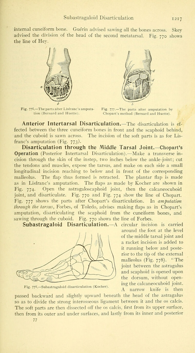 Subastracraloid Disarticulation internal cuneiform bone. Guerin advised sawing all the bones across. Skey advised the division of the head of the second metatarsal. Fig. 770 shows the line of Hev. Fig. 776.—The parts after Lisfranc's amputa- tion (Bernard and Huette). Fig- 777—The parts after amputation by Chopart's method (Bernard and Huette). Anterior Intertarsal Disarticulation.—The disarticulation is ef- fected between the three cuneiform bones in front and the scaphoid behind, and the cuboid is sawn across. The incision of the soft parts is as for Lis- franc's amputation (Fig. 773). Disarticulation through the Middle Tarsal Joint.—Chopart's Operation (Posterior Intertarsal Disarticulation).—Make a transverse in- cision through the skin of the instep, two inches below the ankle-joint; cut the tendons and muscles, expose the tarsus, and make on each side a small longitudinal incision reaching to below and in front of the corresponding malleolus. The flap thus formed is retracted. The plantar flap is made as in Lisfranc's amputation. The flaps as made by Kocher are shown in Fig. 774. Open the astragaloscaphoid joint, then the calcaneocuboid joint, and disarticulate. Fig. 770 and Fig. 774 show the line of Chopart. Fig. 777 shows the parts after Chopart's disarticulation. In amputation through the tarsus, Forbes, of Toledo, advises making flaps as in Chopart's amputation, disarticulating the scaphoid from the cuneiform bones, and sawing through the cuboid. Fig. 770 shows the line of Forbes. Subastragaloid Disarticulation. Fig. 778.—Subastragaloid disarticulation (Kocher). A circular incision is carried around the foot at the level of the middle tarsal joint and a racket incision is added to it running below and poste- rior to the tip of the external malleolus (Fig. 778). The joint between the astragalus and scaphoid is opened upon the dorsum, without open- ing the calcaneocuboid joint. A narrow knife is then passed backward and slightly upward beneath the head of the astragalus so as to divide the strong interosseous ligament between it and the os calcis. The soft parts are then dissected off the os calcis, first from its upper surface, then from its outer and under surfaces, and lastly from its inner and posterior 77