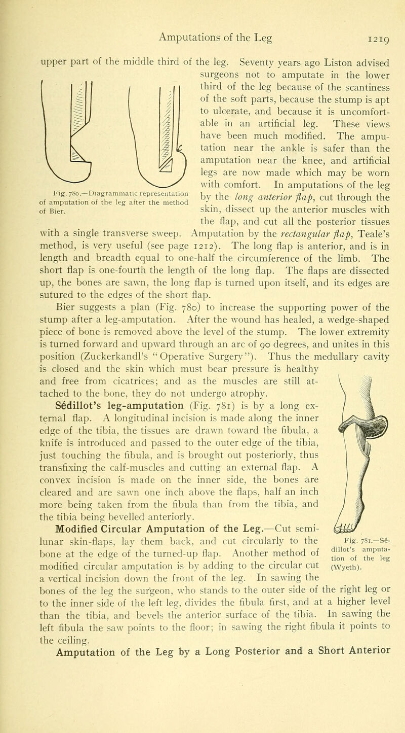 Fig. 7S0.—Diagramnialic representation of amputation of the leg after the method of Bier. upper part of the middle third of the leg. Seventy years ago Liston advised surgeons not to amputate in the lower third of the leg because of the scantiness of the soft parts, because the stump is apt to ulcerate, and because it is uncomfort- able in an artificial leg. These views have been much modified. The ampu- tation near the ankle is safer than the amputation near the knee, and artificial legs are now made which may be worn with comfort. In amputations of the leg by the long anterior flap, cut through the skin, dissect up the anterior muscles with the flap, and cut all the posterior tissues with a single transverse sweep. Amputation by the rectangular f,ap, Teale's method, is very useful (see page 1212). The long flap is anterior, and is in length and breadth equal to one-half the circumference of the limb. The short flap is one-fourth the length of the long flap. The flaps are dissected up, the bones are sawn, the long flap is turned upon itself, and its edges are sutured to the edges of the short flap. Bier suggests a plan (Fig. 780) to increase the supporting power of the stump after a leg-amputation. After the wound has healed, a wedge-shaped piece of bone is removed above the level of the stump. The lower extremity is turned forward and upward through an arc of 90 degrees, and unites in this position (Zuckerkandl's Operative Surgery). Thus the medullary cavity is closed and the skin which must bear pressure is healthy and free from cicatrices; and as the muscles are still at- tached to the bone, they do not undergo atrophy. Sedillot's leg-amputation (Fig. 781) is by a long ex- ternal flap. A longitudinal incision is made along the inner edge of the tibia, the tissues are drawn toward the fibula, a knife is introduced and passed to the outer edge of the tibia, just touching the fibula, and is brought out posteriorly, thus transfixing the calf-muscles and cutting an external flap. A convex incision is made on the inner side, the bones are cleared and are sawn one inch above the flaps, half an inch more being taken from the fibula than from the tibia, and the tibia being bevelled anteriorly. Modified Circular Amputation of the Leg.—Cut semi- lunar skin-flaps, lay them back, and cut circularly to the bone at the edge of the turned-up flap. Another method of modified circular amputation is by adding to the circular cut a vertical incision down the front of the leg. In sawing the bones of the leg the surgeon, who stands to the outer side of the right leg or to the inner side of the left leg, divides the fibula first, and at a higher level than the tibia, and bevels the anterior surface of the tibia. In sawing the left fibula the saw points to the floor; in sawing the right fibula it points to the ceiling. Amputation of the Leg by a Long Posterior and a Short Anterior Fig. 781.—Se- dillot's amputa- tion of the leg (Wyeth).