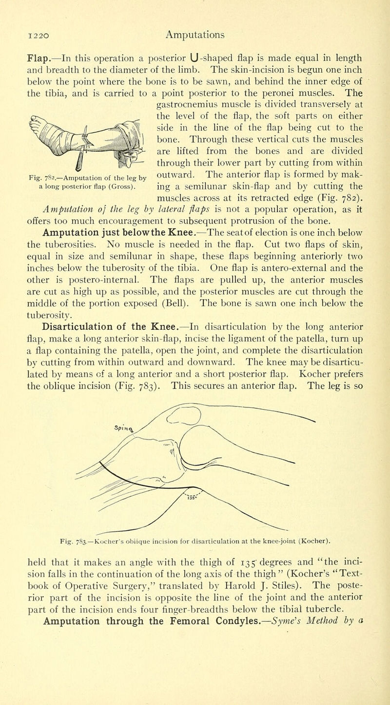 Fig. 782.—Amputation of the leg by a long posterior flap (Gross). Flap.—In this operation a posterior U-shaped flap is made equal in length and breadth to the diameter of the limb. The skin-incision is begun one inch below the point where the bone is to be sawn, and behind the inner edge of the tibia, and is carried to a point posterior to the peronei muscles. The gastrocnemius muscle is divided transversely at the level of the flap, the soft parts on either side in the line of the flap being cut to the bone. Through these vertical cuts the muscles are lifted from the bones and are divided through their lower part by cutting from within outward. The anterior flap is formed by mak- ing a semilunar skin-flap and by cutting the muscles across at its retracted edge (Fig. 782). Amputation of the leg by lateral flaps is not a popular operation, as it offers too much encouragement to subsequent protrusion of the bone. Amputation just belowthe Knee.—The seat of election is one inch below the tuberosities. No muscle is needed in the flap. Cut two flaps of skin, equal in size and semilunar in shape, these flaps beginning anteriorly two inches below the tuberosity of the tibia. One flap is antero-external and the other is postero-internal. The flaps are pulled up, the anterior m.uscles are cut as high up as possible, and the posterior muscles are cut through the middle of the portion exposed (Bell). The bone is sawn one inch below the tuberosity. Disarticulation of the Knee.—In disarticulation by the long anterior flap, make a long anterior skin-flap, incise the ligament of the patella, turn up a flap containing the patella, open the joint, and complete the disarticulation by cutting from within outward and downward. The knee may be disarticu- lated by means of a long anterior and a short posterior flap. Kocher prefers the oblique incision (Fig. 783). This secures an anterior flap. The leg is so Fig- 7S3.— Kocher's oblique incision for disarticulation at the knee-joint (Kocher). held that it makes an angle with the thigh of 135'degrees and the inci- sion falls in the continuation of the long axis of the thigh (Kocher's Text- book of Operative Surgery, translated by Harold J. Stiles). The poste- rior part of the incision is opposite the line of the joint and the anterior part of the incision ends four finger-breadths below the tibial tubercle. Amputation through the Femoral Condyles.—Syme's Method hy a