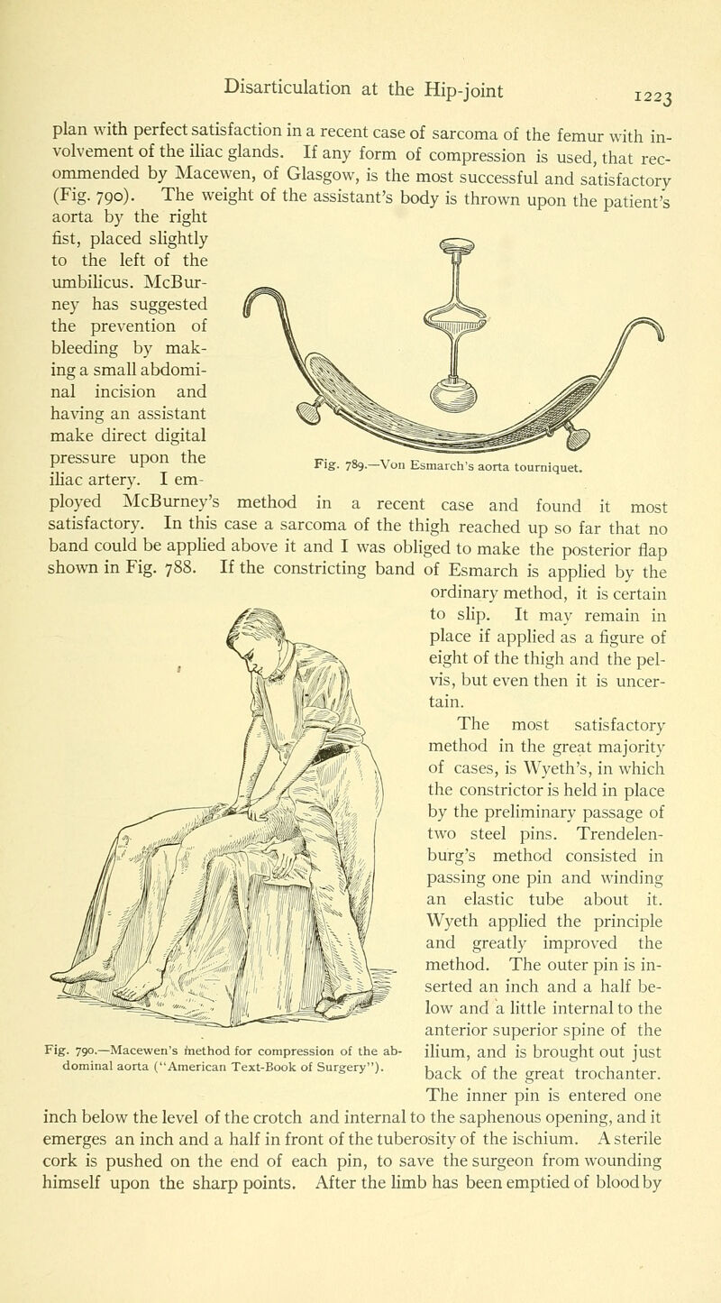 Fig. 789.—Von Esmarch's aorta tourniquet. plan with perfect satisfaction in a recent case of sarcoma of the femur with in- volvement of the ihac glands. If any form of compression is used, that rec- ommended by Macewen, of Glasgow, is the most successful and satisfactory (Fig. 790). The weight of the assistant's body is thrown upon the patient's aorta by the right fist, placed slightly to the left of the umbilicus. McBur- ney has suggested the prevention of bleeding by mak- ing a small abdomi- nal incision and having an assistant make direct digital pressure upon the ihac artery. I em- ployed McBurney's method in a recent case and found it most satisfactory. In this case a sarcoma of the thigh reached up so far that no band could be applied above it and I was obHged to make the posterior flap shown in Fig. 788. If the constricting band of Esmarch is appHed by the ordinary method, it is certain to shp. It may remain in place if applied as a figure of eight of the thigh and the pel- vis, but even then it is uncer- tain. The most satisfactory method in the great majority of cases, is Wyeth's, in which the constrictor is held in place by the preliminary passage of two steel pins. Trendelen- burg's method consisted in passing one pin and winding an elastic tube about it. Wyeth appHed the principle and greatly improved the method. The outer pin is in- serted an inch and a half be- low and a little internal to the anterior superior spine of the ilium, and is brought out just back of the great trochanter. The inner pin is entered one inch below the level of the crotch and internal to the saphenous opening, and it emerges an inch and a half in front of the tuberosity of the ischium. A sterile cork is pushed on the end of each pin, to save the surgeon from wounding himself upon the sharp points. After the limb has been emptied of blood by Fig. 790.—Macewen's fnethod for compression of the ab- dominal aorta (American Text-Book of Surgery).