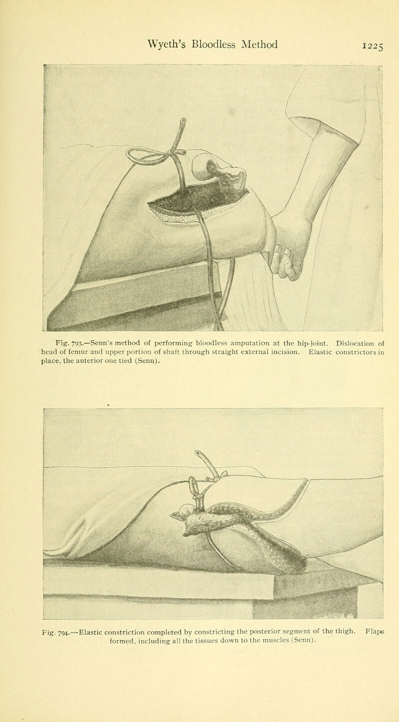 Wyeth's Bloodless Method Fig- 793-—Senn's method of performing bloodless amputation at the hip-joint. Dislocation of head of femur and upper portion of shaft through straight external incision. Elastic constrictors in place, the anterior one tied (Senn). Fig. 794-- -Elastic constriction completed by constricting the posterior segment of the thigh, formed, including all the tissues down to the muscles (Senn). Flaps