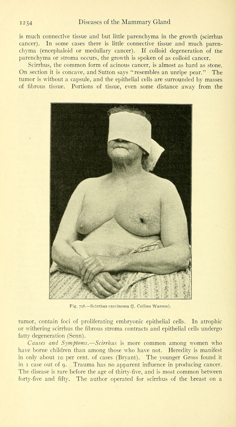 is much connective tissue and but little parenchyma in the growth (scirrhus cancer). In some cases there is little connective tissue and much paren- chyma (encephaloid or medullary cancer). If colloid degeneration of the parenchyma or stroma occurs, the grov^rth is spoken of as colloid cancer. Scirrhus, the common form of acinous cancer, is almost as hard as stone. On section it is concave, and Sutton says resembles an unripe pear. The tumor is without a capsule, and the epithelial cells are surrounded by masses of fibrous tissue. Portions of tissue, even some distance away from the Fig. 798.—Scirrhus carcinoma (J. Collins Warren). tumor, contain foci of proliferating embryonic epithelial cells. In atrophic or withering scirrhus the fibrous stroma contracts and epithelial cells undergo fatty degeneration (Senn). Causes and Symptoms.—Scirrhus is more common among women who have borne children than among those who have not. Heredity is manifest in only about 10 per cent, of cases (Bryant). The younger Gross found it in I case out of 9. Trauma has no apparent influence in producing cancer. The disease is rare before the age of thirty-five, and is most common between forty-five and fifty. The author operated for scirrhus of the breast on a
