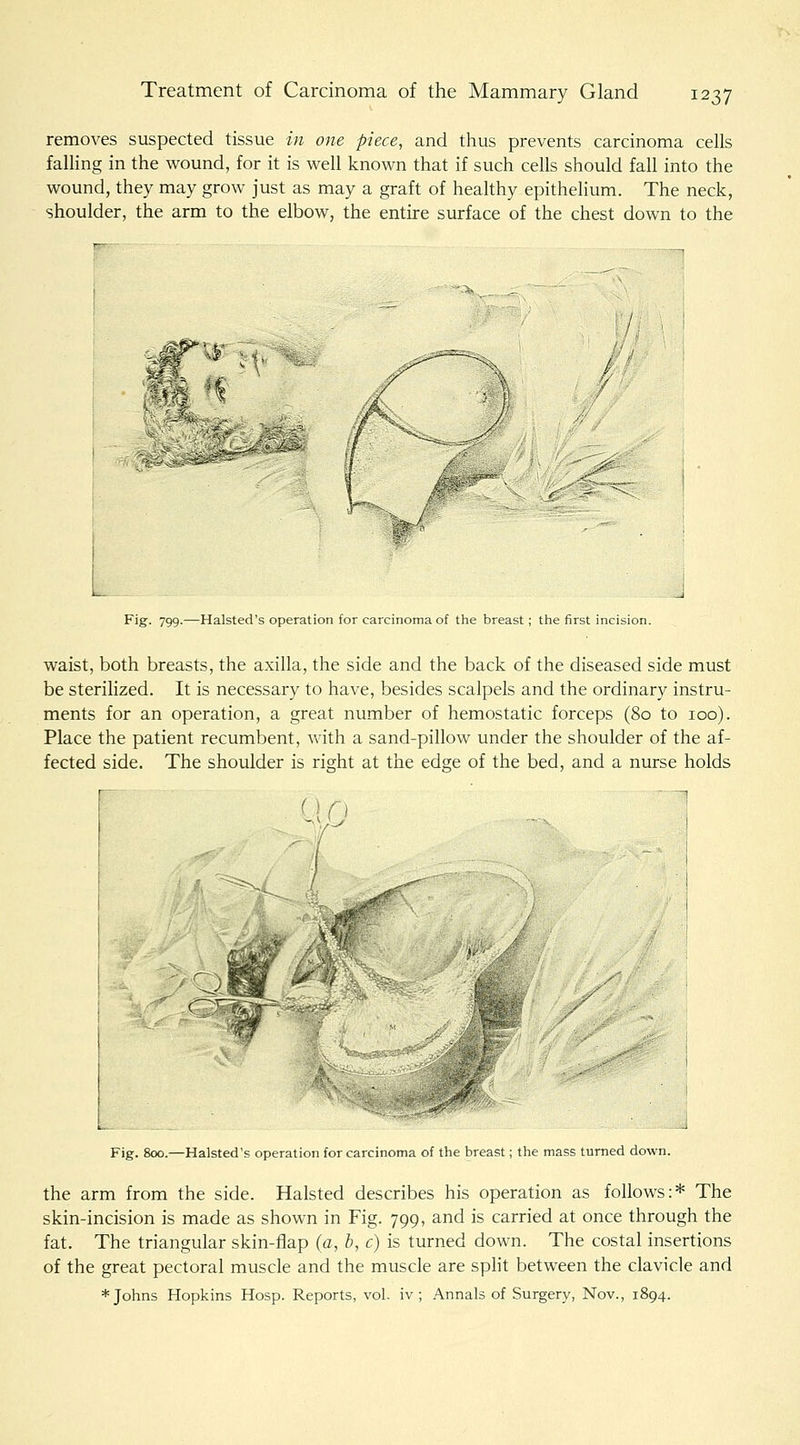 removes suspected tissue in one piece, and thus prevents carcinoma cells falling in the wound, for it is well known that if such cells should fall into the wound, they may grow just as may a graft of healthy epithelium. The neck, shoulder, the arm to the elbow, the entire surface of the chest down to the L Fig. 799.—Halsted's operation for carcinoma of the breast; the first incision. waist, both breasts, the axilla, the side and the back of the diseased side must be sterilized. It is necessary to have, besides scalpels and the ordinary instru- ments for an operation, a great number of hemostatic forceps (80 to 100). Place the patient recumbent, with a sand-pillow under the shoulder of the af- fected side. The shoulder is right at the edge of the bed, and a nurse holds '•n ' ^ Fig. 800.—Halsted's operation for carcinoma of the breast; the mass turned down. the arm from the side. Halsted describes his operation as follows:* The skin-incision is made as shown in Fig. 799, and is carried at once through the fat. The triangular skin-flap (a, b, c) is turned down. The costal insertions of the great pectoral muscle and the muscle are spht between the clavicle and * Johns Hopkins Hosp. Reports, vol. iv ; Annals of Surgery, Nov., 1894.