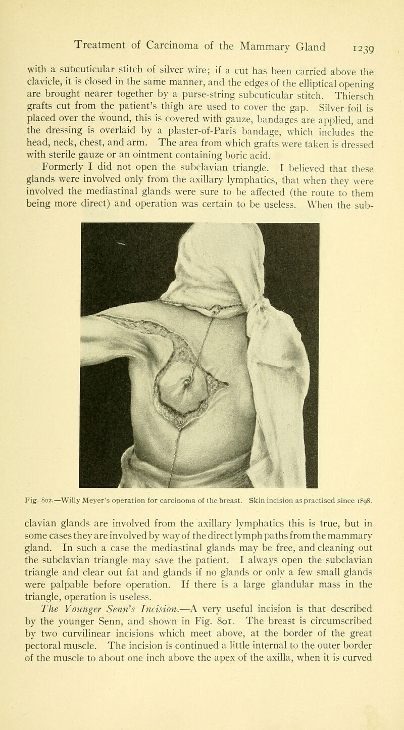 with a subcuticular stitch of silver wire; if a cut has been carried above the clavicle, it is closed in the same manner, and the edges of the elliptical opening are brought nearer together by a purse-string subcuticular stitch. Thiersch grafts cut from the patient's thigh are used to cover the gap. Silver-foil is placed over the wound, this is covered with gauze, bandages are applied, and the dressing is overlaid by a plaster-of-Paris bandage, which includes the head, neck, chest, and arm. The area from which grafts were taken is dressed with sterile gauze or an ointment containing boric acid. Formerly I did not open the subclavian triangle. I believed that these glands were involved only from the axillary lymphatics, that when they were involved the mediastinal glands were sure to be affected (the route to them being more direct) and operation was certain to be useless. When the sub- / 1 -^ Fig. 802.—Willy Meyer's operation for carcinoina of the breast. Skin incision as practised since i?g8. clavian glands are involved from the axillary lymphatics this is true, but in some cases they are involved by way of the direct lymph paths from the mammary gland. In such a case the mediastinal glands may be free, and cleaning out the subclavian triangle may save the patient. I always open the subclavian triangle and clear out fat and glands if no glands or only a few small glands were palpable before operation. If there is a large glandular mass in the triangle, operation is useless. The Younger Semi's Incision.—A very useful incision is that described by the younger Senn, and shown in Fig. 801. The breast is circumscribed by two curvilinear incisions which meet above, at the border of the great pectoral muscle. The incision is continued a little internal to the outer border of the muscle to about one inch above the apex of the axilla, when it is curved