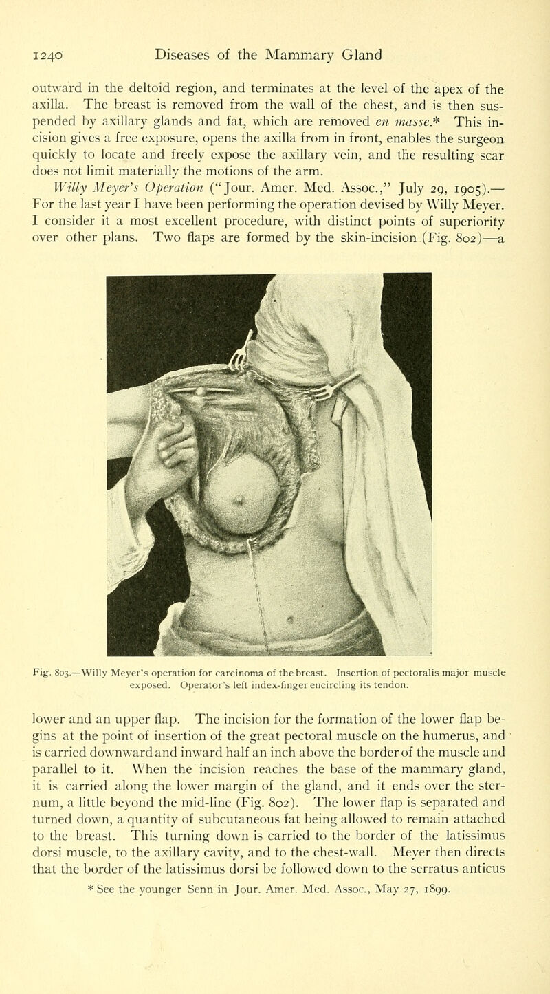outward in the dehoid region, and terminates at the level of the apex of the axilla. The breast is removed from the wall of the chest, and is then sus- pended by axillary glands and fat, which are removed en masse:^ This in- cision gives a free exposure, opens the axilla from in front, enables the surgeon quickly to locate and freely expose the axillary vein, and the resulting scar does not limit materially the motions of the arm. Willy Meyer's Operation (Jour. Amer. Med. Assoc, July 29, 1905).— For the last year I have been performing the operation devised by Willy Meyer. I consider it a most excellent procedure, with distinct points of superiority over other plans. Two flaps are formed by the skin-incision (Fig. 802)—a Fig. 803.—Willy Meyer's operation for carcinoma of the breast. Insertion of pectoralis major muscle exposed. Operator's left index-finger encircling its tendon. lower and an upper flap. The incision for the formation of the lower flap be- gins at the point of insertion of the great pectoral muscle on the humerus, and is carried downward and inward half an inch above the border of the muscle and parallel to it. When the incision reaches the base of the mammary gland, it is carried along the lower margin of the gland, and it ends over the ster- num, a little beyond the mid-Hne (Fig. 802). The lower flap is separated and turned down, a quantity of subcutaneous fat being allowed to remain attached to the breast. This turning down is carried to the border of the latissimus dorsi muscle, to the axillary cavity, and to the chest-wall. Meyer then directs that the border of the latissimus dorsi be followed down to the serratus anticus * See the younger Senn in Jour. Amer. Med. Assoc, May 27, 1899.