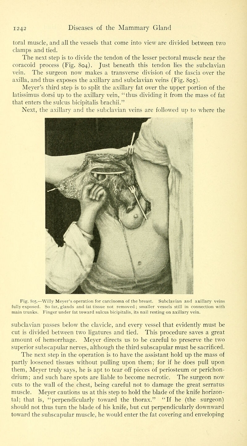 toral muscle, and all the vessels that come into view are divided between two clamps and tied. The next step is to divide the tendon of the lesser pectoral muscle near the coracoid process (Fig. 804). Just beneath this tendon lies the subclavian vein. The surgeon now makes a transverse division of the fascia over the axilla, and thus exposes the axillary and subclavian veins (Fig. 805). Meyer's third step is to split the axillary fat over the upper portion of the latissimus dorsi up to the axillary vein, thus dividing it from the mass of fat that enters the sulcus bicipitalis brachii. Next, the axillary and the subclavian veins are followed up to where the Fig. 805.—Willy Meyer's operation for carcinoma of the breast. Subclavian and axillary veins fully exposed. So far, glands and fat tissue not removed ; smaller vessels still in connection with main trunks. Finger under fat toward sulcus bicipitalis, its nail resting on axillary vein. subclavian passes below the clavicle, and every vessel that evidently must be cut is divided between two ligatures and tied. This procedure saves a great amount of hemorrhage. Meyer directs us to be careful to preserve the two superior subscapular nerves, although the third subscapular must be sacrificed. The next step in the operation is to have the assistant hold up the mass of partly loosened tissues without pulhng upon them; for if he does pull upon them, Meyer truly says, he is apt to tear off pieces of periosteum or perichon- drium; and such bare spots are liable to become necrotic. The surgeon now cuts to the wall of the chest, being careful not to damage the great serratus muscle. Meyer cautions us at this step to hold the blade of the knife horizon- tal; that is, perpendicularly toward the thorax. If he (the surgeon) should not thus turn the blade of his knife, but cut perpendicularly downward toward the subscapular muscle, he would enter the fat covering and enveloping