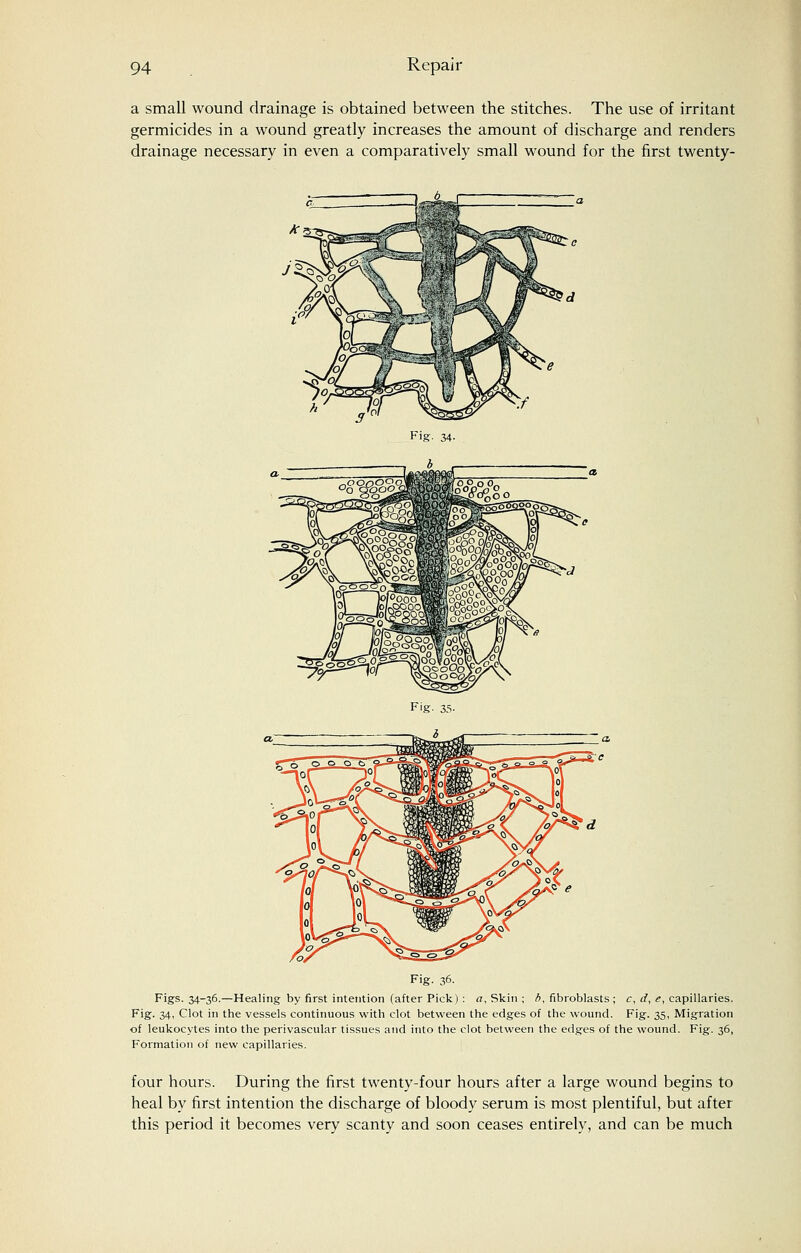 a small wound drainage is obtained between the stitches. The use of irritant germicides in a wound greatly increases the amount of discharge and renders drainage necessary in even a comparatively small wound for the first twenty- Fig- 36. Figs. 34-36.—Healing by first intention (after Pick) : a. Skin ; b, fibroblasts ; c, d, <?, capillaries. Fig. 34, Clot in the vessels continuous with clot between the edges of the wound. Fig. 35, Migration of leukocytes into the perivascular tissues atid into the clot between the edges of the wound. Fig. 36, Formation of new capillaries. four hours. During the first twenty-four hours after a large wound begins to heal by first intention the discharge of bloody serum is most plentiful, but after this period it becomes very scanty and soon ceases entirely, and can be much