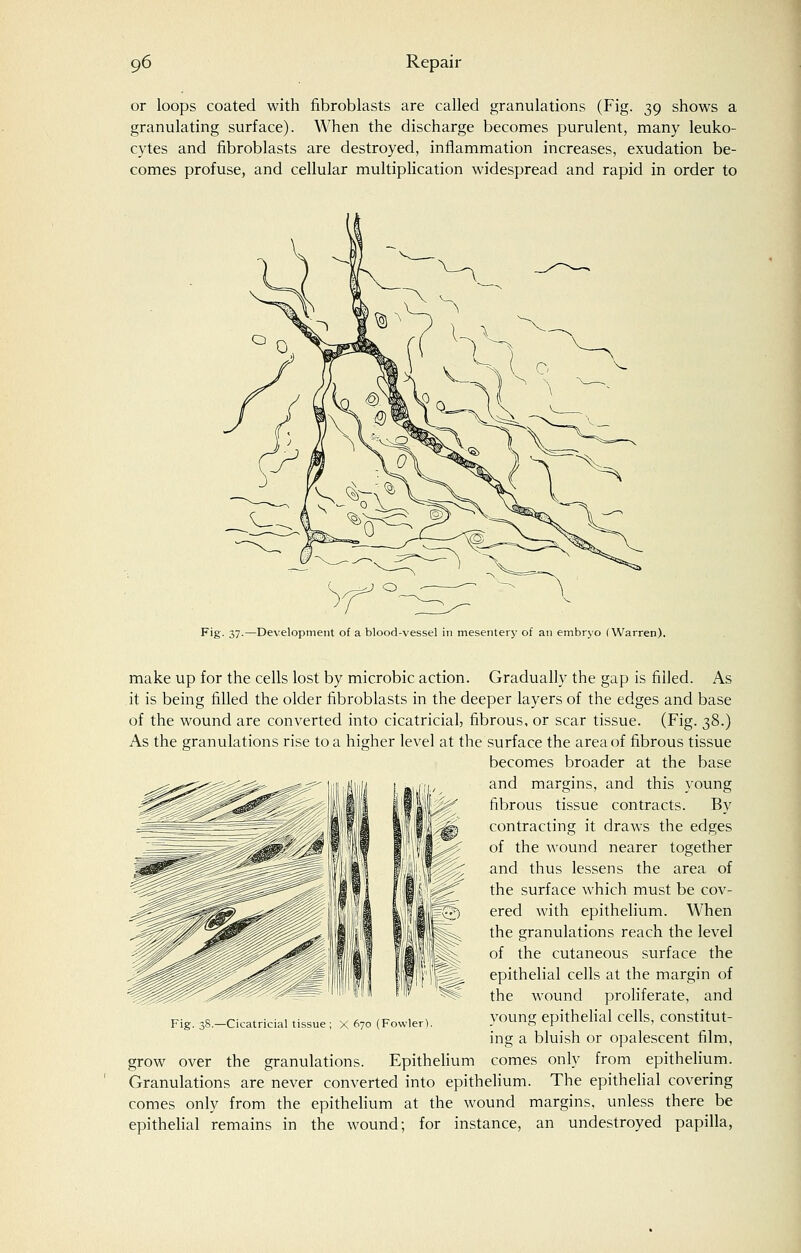 or loops coated with fibroblasts are called granulations (Fig. 39 shows a granulating surface). When the discharge becomes purulent, many leuko- cytes and fibroblasts are destroyed, inflammation increases, exudation be- comes profuse, and cellular multiplication widespread and rapid in order to Fig- 37-—Development of a blood-vessel in mesentery of an embryo (Warren). make up for the cells lost by microbic action. Gradually the gap is filled. As it is being filled the older fibroblasts in the deeper layers of the edges and base of the wound are converted into cicatricial, fibrous, or scar tissue. (Fig. 38.) As the granulations rise to a higher level at the surface the area of fibrous tissue becomes broader at the base and margins, and this young fibrous tissue contracts. By contracting it draws the edges of the wound nearer together and thus lessens the area of the surface which must be cov- ered with epithelium. When the granulations reach the level of the cutaneous surface the epithelial cells at the margin of the wound proliferate, and young epithelial cells, constitut- ing a bluish or opalescent film, grow over the granulations. Epithelium comes only from epithelium. Granulations are never converted into epithelium. The epithelial covering comes only from the epithelium at the wound margins, unless there be epithelial remains in the wound; for instance, an undestroyed papilla, Fig. 38.—Cicatricial tissue; X 670 (Fowler).
