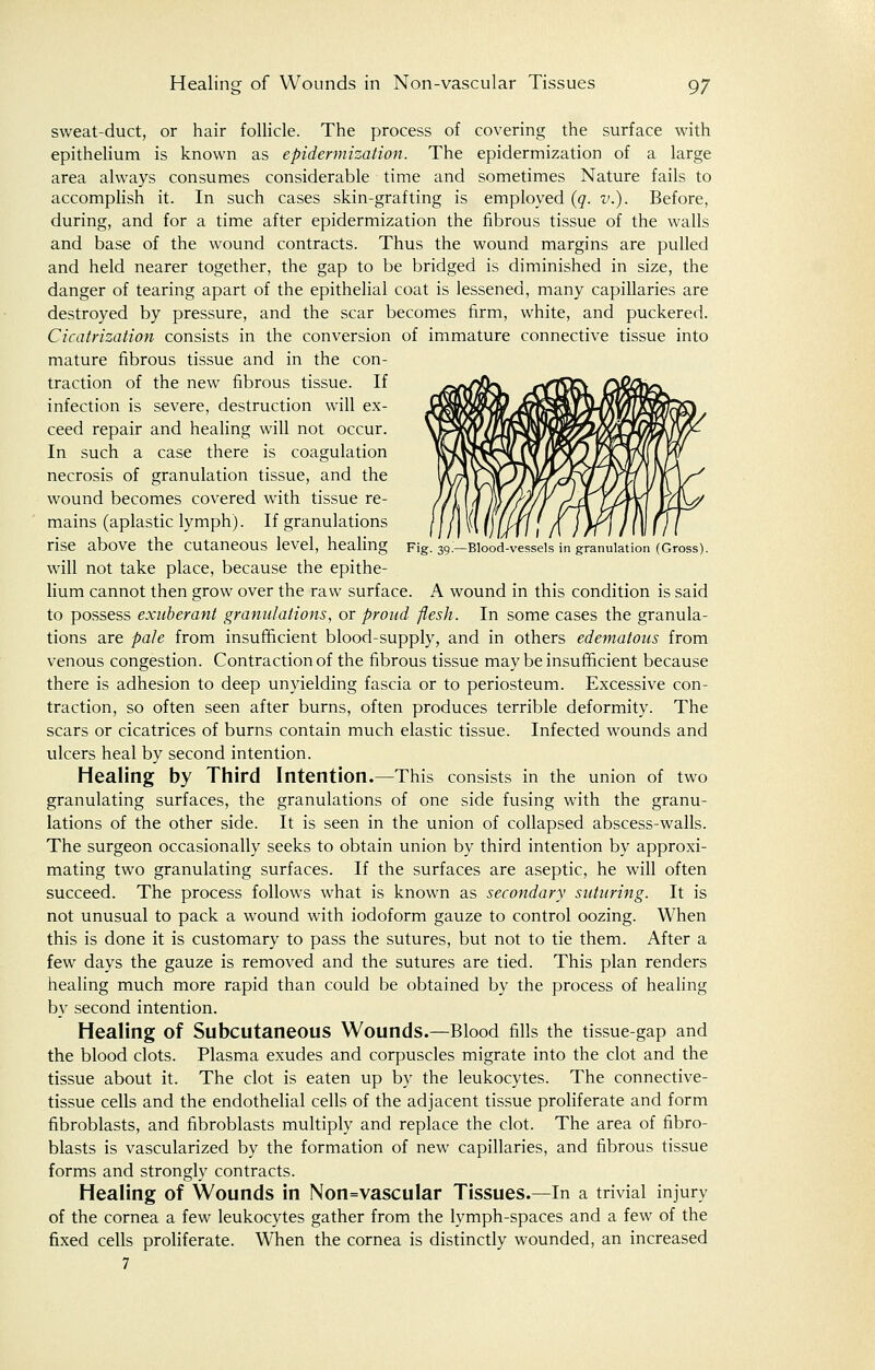 sweat-duct, or hair follicle. The process of covering the surface with epithelium is known as epidermization. The epidermization of a large area always consumes considerable time and sometimes Nature fails to accomplish it. In such cases skin-grafting is employed (q. v.). Before, during, and for a time after epidermization the fibrous tissue of the walls and base of the wound contracts. Thus the wound margins are pulled and held nearer together, the gap to be bridged is diminished in size, the danger of tearing apart of the epithelial coat is lessened, many capillaries are destroyed by pressure, and the scar becomes firm, white, and puckered. Cicatrization consists in the conversion of immature connective tissue into mature fibrous tissue and in the con- traction of the new fibrous tissue. If infection is severe, destruction will ex- ceed repair and healing will not occur. In such a case there is coagulation necrosis of granulation tissue, and the wound becomes covered with tissue re- mains (aplastic lymph). If granulations rise above the CUtaneOUS level, healing Fig. 39:—Blood-vessels in'granulation (Gross). will not take place, because the epithe- lium cannot then grow over the raw surface. A wound in this condition is said to possess exuberant granulations, or proud flesh. In some cases the granula- tions are pale from insufficient blood-supply, and in others edematous from venous congestion. Contraction of the fibrous tissue may be insufficient because there is adhesion to deep unyielding fascia or to periosteum. Excessive con- traction, so often seen after burns, often produces terrible deformity. The scars or cicatrices of burns contain much elastic tissue. Infected wounds and ulcers heal by second intention. Healing by Third Intention.—This consists in the union of two granulating surfaces, the granulations of one side fusing with the granu- lations of the other side. It is seen in the union of collapsed abscess-walls. The surgeon occasionally seeks to obtain union by third intention by approxi- mating two granulating surfaces. If the surfaces are aseptic, he will often succeed. The process follows what is known as secondary suturing. It is not unusual to pack a wound with iodoform gauze to control oozing. When this is done it is customary to pass the sutures, but not to tie them. After a few days the gauze is removed and the sutures are tied. This plan renders healing much more rapid than could be obtained by the process of healing by second intention. Healing of Subcutaneous Wounds.—Blood fills the tissue-gap and the blood clots. Plasma exudes and corpuscles migrate into the clot and the tissue about it. The clot is eaten up by the leukocytes. The connective- tissue cells and the endothelial cells of the adjacent tissue proliferate and form fibroblasts, and fibroblasts multiply and replace the clot. The area of fibro- blasts is vascularized by the formation of new capillaries, and fibrous tissue forms and strongly contracts. Healing of Wounds in Nonvascular Tissues.—In a trivial injury of the cornea a few leukocytes gather from the lymph-spaces and a few of the fixed cells proliferate. When the cornea is distinctly wounded, an increased 7