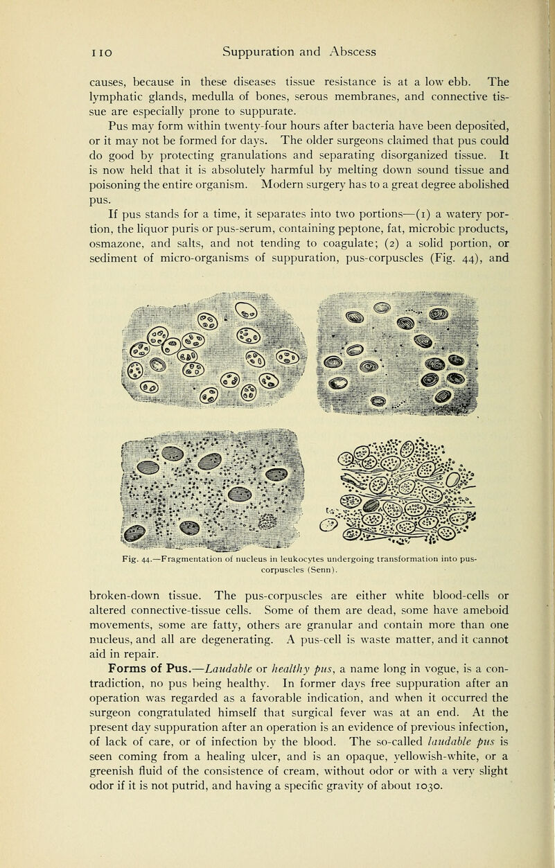 causes, because in these diseases tissue resistance is at a low ebb. The lymphatic glands, medulla of bones, serous membranes, and connective tis- sue are especially prone to suppurate. Pus may form within twenty-four hours after bacteria have been deposited, or it may not be formed for days. The older surgeons claimed that pus could do good by protecting granulations and separating disorganized tissue. It is now held that it is absolutely harmful by melting down sound tissue and poisoning the entire organism. Modern surgery has to a great degree abolished pus. If pus stands for a time, it separates into two portions—(i) a watery por- tion, the liquor puris or pus-serum, containing peptone, fat, microbic products, osmazone, and salts, and not tending to coagulate; (2) a solid portion, or sediment of micro-organisms of suppuration, pus-corpuscles (Fig. 44), and :<£> r^mjfiX '■■■-■ ■ ■•■. ■■:XJ.:-„'a-a! * * Fip- AA Fragmentation of nucleus in leukocytes undergoing transformation into pus- corpuscles (Senn). broken-down tissue. The pus-corpuscles are either white blood-cells or altered connective-tissue cells. Some of them are dead, some have ameboid movements, some are fatty, others are granular and contain more than one nucleus, and all are degenerating. A pus-cell is waste matter, and it cannot aid in repair. Forms of Pus.—Laudable or healthy pus, a name long in vogue, is a con- tradiction, no pus being healthy. In former days free suppuration after an operation was regarded as a favorable indication, and when it occurred the surgeon congratulated himself that surgical fever was at an end. At the present day suppuration after an operation is an evidence of previous infection, of lack of care, or of infection by the blood. The so-called laudable pus is seen coming from a healing ulcer, and is an opaque, yellowish-white, or a greenish fluid of the consistence of cream, without odor or with a very slight odor if it is not putrid, and having a specific gravity of about 1030.