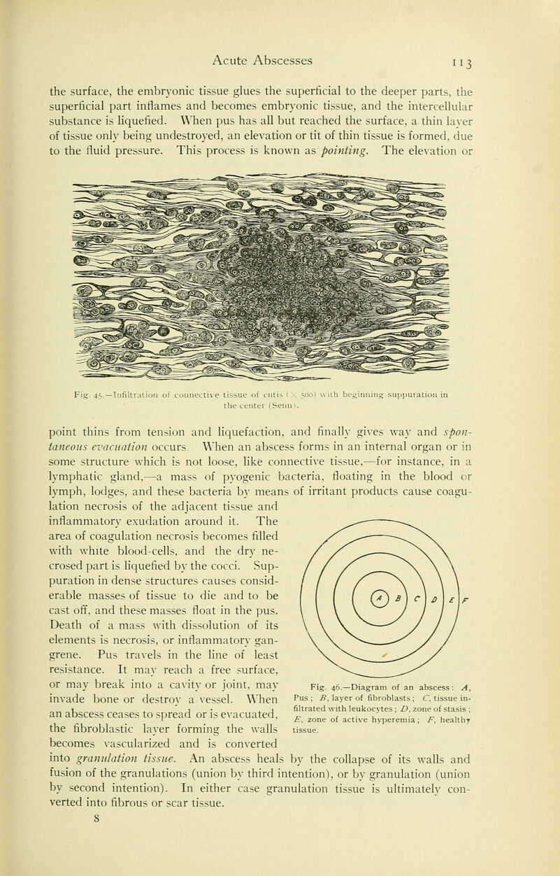 Acute Abscesses the surface, the embryonic tissue glues the superficial to the deeper parts, the superficial part inflames and becomes embryonic tissue, and the intercellular substance is liquefied. When pus has all but reached the surface, a thin layer of tissue only being undestroyed, an elevation or tit of thin tissue is formed, due to the fluid pressure. This process is known as,'pointing. The elevation or Iml 45. —Infiltration of connective tissue of cutis (X 500) with beginning suppuration in the center (Semi). point thins from tension and liquefaction, and finally gives way and spon- taneous evacuation occurs. When an abscess forms in an internal organ or in some structure which is not loose, like connective tissue,—for instance, in a lymphatic gland,—a mass of pyogenic bacteria, floating in the blood or lymph, lodges, and these bacteria by means of irritant products cause coagu- lation necrosis of the adjacent tissue and inflammatory exudation around it. The area of coagulation necrosis becomes filled with white blood-cells, and the dry ne- crosed part is liquefied by the cocci. Sup- puration in dense structures causes consid- erable masses of tissue to die and to be cast off, and these masses float in the pus. Death of a mass with dissolution of its elements is necrosis, or inflammatory gan- grene. Pus travels in the line of least resistance. It may reach a free surface, or may break into a cavity or joint, may invade bone or destroy a vessel. When an abscess ceases to spread or is evacuated, the fibroblastic layer forming the walls becomes vascularized and is converted into granulation tissue. An abscess heals by the collapse of its walls and fusion of the granulations (union by third intention), or by granulation (union by second intention). In either case granulation tissue is ultimately con- verted into fibrous or scar tissue. Fig. 46.—Diagram of an abscess : A, Pus ; B, layer of fibroblasts ; C, tissue in- filtrated with leukocytes ; £>, zone of stasis ; E, zone of active hyperemia; F, healthy tissue.
