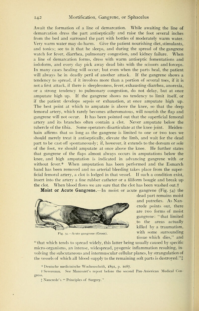 Await the formation of a line of demarcation. While awaiting the line of demarcation dress the part antiseptically and raise the foot several inches from the bed and surround the part with bottles of moderately warm water. Very warm water may do harm. Give the patient nourishing diet, stimulants, and tonics; see to it that he sleeps, and during the spread of the gangrene watch for fever, diarrhea, pulmonary congestion, and kidney failure. When a line of demarcation forms, dress with warm antiseptic fomentations and iodoform, and every day pick away dead bits with the scissors and forceps. In many cases healing will occur; but even when the parts heal, the patient will always be in deadly peril of another attack. If the gangrene shows a tendency to spread, if it involves more than a portion of several toes, if it is not a first attack, if there is sleeplessness, fever, exhausting diarrhea, anorexia, or a strong tendency to pulmonary congestion, do not delay, but at once amputate high up. If the gangrene shows no tendency to limit itself, or if the patient develops sepsis or exhaustion, at once amputate high up. The best point at which to amputate is above the knee, so that the deep femoral artery, which rarely becomes atheromatous, will nourish the flap and gangrene will not occur. It has been pointed out that the superficial femoral artery and its branches often contain a clot. Never amputate below the tubercle of the tibia. Some operators disarticulate at the knee-joint. Heiden- hain affirms that so long as the gangrene is limited to one or two toes we should merely treat it antiseptically, elevate the limb, and wait for the dead part to be cast off spontaneously; if, however, it extends to the dorsum or sole of the foot, we should amputate at once above the knee. He further states that gangrene of the flaps almost always occurs in amputations below the knee, and high amputation is indicated in advancing gangrene with or without fever.* Wlien amputation has been performed and the Esmarch band has been removed and no arterial bleeding takes place from the super- ficial femoral artery, a clot is lodged in that vessel. If such a condition exist, insert into the artery a fine rubber catheter or a filiform bougie and break up the clot. When blood flows we are sure that the clot has been washed out.f Moist or Acute Gangrene.—In moist or acute gangrene (Fig. 54) the dead part remains moist and putrefies. As Nan- crede points out, there are two forms of moist gangrene: that limited to the areas actually killed by a traumatism, with some surrounding tissue which dies, and  that which tends to spread widely, this latter being usually caused by specific micro-organisms, an intense, widespread, pyogenic inflammation resulting, in- volving the subcutaneous and intermuscular cellular planes, by strangulation of the vessels of which all blood-supply to the remaining soft parts is destroyed.! * Deutsche medicinische Wochenschrift, 1891, p. 1087. f Severeanu. See Mancozet's report before the second Pan-American Medical Con- Fig. 54.—Acute gangrene (Gross). JNancrede's  Principles of Surgery.