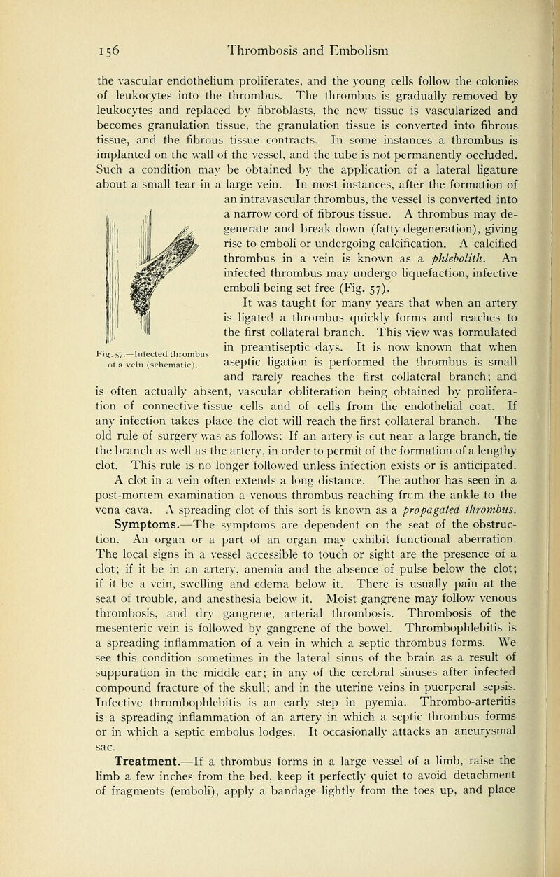 Kigf. 57.—Infected thrombus of a vein (schematic). the vascular endothelium proliferates, and the young cells follow the colonies of leukocytes into the thrombus. The thrombus is gradually removed by leukocytes and replaced by fibroblasts, the new tissue is vascularized and becomes granulation tissue, the granulation tissue is converted into fibrous tissue, and the fibrous tissue contracts. In some instances a thrombus is implanted on the wall of the vessel, and the tube is not permanently occluded. Such a condition may be obtained by the application of a lateral ligature about a small tear in a large vein. In most instances, after the formation of an intravascular thrombus, the vessel is converted into a narrow cord of fibrous tissue. A thrombus may de- generate and breakdown (fatty degeneration), giving rise to emboli or undergoing calcification. A calcified thrombus in a vein is known as a phlebolith. An infected thrombus may undergo liquefaction, infective emboli being set free (Fig. 57). It was taught for many years that when an artery is ligated a thrombus quickly forms and reaches to the first collateral branch. This view was formulated in preantiseptic days. It is now known that when aseptic ligation is performed the thrombus is small and rarely reaches the first collateral branch; and is often actually absent, vascular obliteration being obtained by prolifera- tion of connective-tissue cells and of cells from the endothelial coat. If any infection takes place the clot will reach the first collateral branch. The old rule of surgery was as follows: If an artery is cut near a large branch, tie the branch as well as the artery, in order to permit of the formation of a lengthy clot. This rule is no longer followed unless infection exists or is anticipated. A clot in a vein often extends a long distance. The author has seen in a post-mortem examination a venous thrombus reaching from the ankle to the vena cava. A spreading clot of this sort is known as a propagated thrombus. Symptoms.—The symptoms are dependent on the seat of the obstruc- tion. An organ or a part of an organ may exhibit functional aberration. The local signs in a vessel accessible to touch or sight are the presence of a clot; if it be in an artery, anemia and the absence of pulse below the clot; if it be a vein, swelling and edema below it. There is usually pain at the seat of trouble, and anesthesia below it. Moist gangrene may follow venous thrombosis, and dry gangrene, arterial thrombosis. Thrombosis of the mesenteric vein is followed by gangrene of the bowel. Thrombophlebitis is a spreading inflammation of a vein in which a septic thrombus forms. We see this condition sometimes in the lateral sinus of the brain as a result of suppuration in the middle ear; in any of the cerebral sinuses after infected compound fracture of the skull; and in the uterine veins in puerperal sepsis. Infective thrombophlebitis is an early step in pyemia. Thrombo-arteritis is a spreading inflammation of an artery in which a septic thrombus forms or in which a septic embolus lodges. It occasionally attacks an aneurysmal sac. Treatment.—If a thrombus forms in a large vessel of a limb, raise the limb a few inches from the bed, keep it perfectly quiet to avoid detachment of fragments (emboli), apply a bandage lightly from the toes up, and place