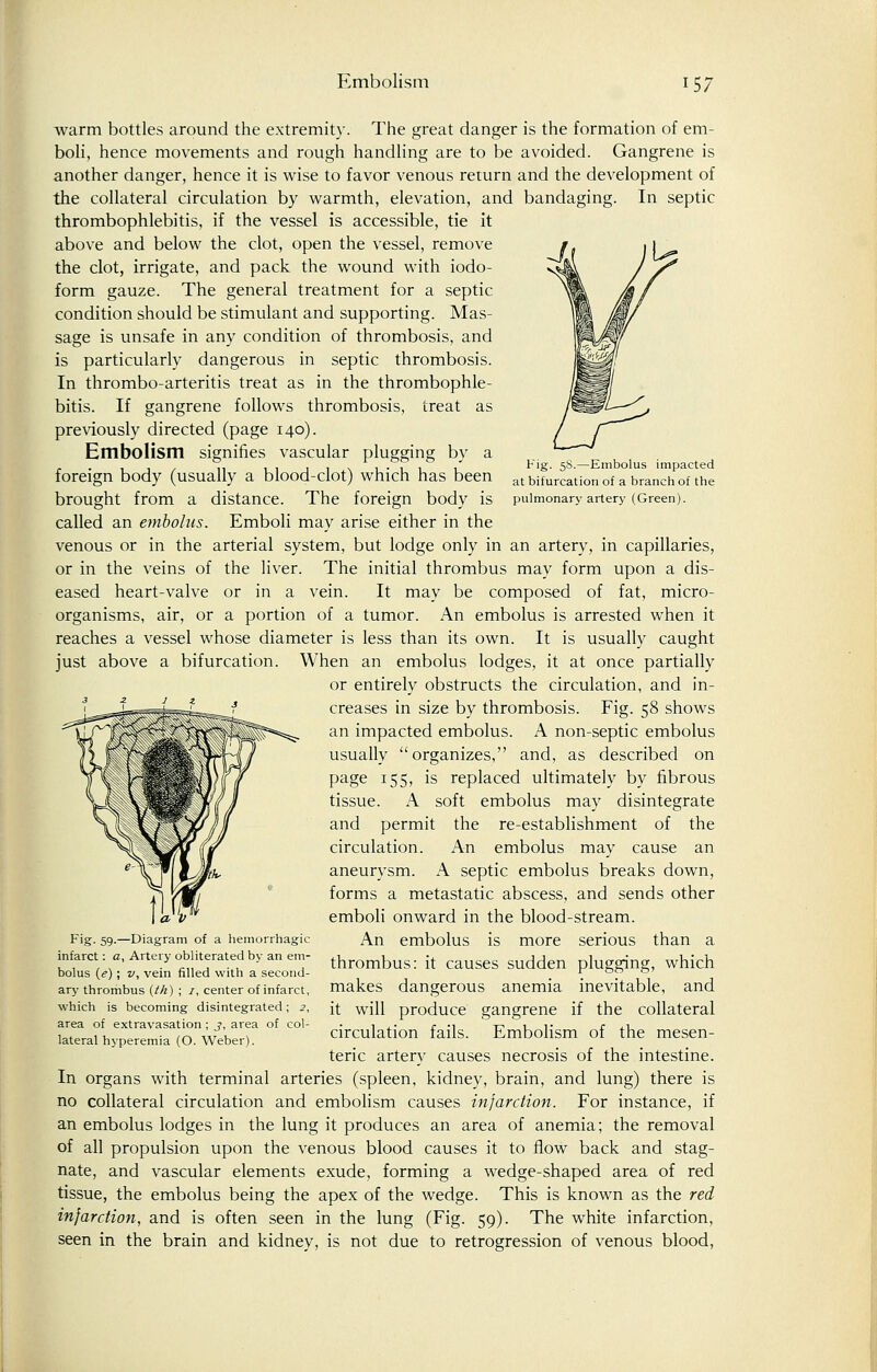 Embolism Fig. 58.—Embolus impacted at bifurcation of a branch of the pulmonary artery (Green). warm bottles around the extremity. The great danger is the formation of em- boli, hence movements and rough handling are to be avoided. Gangrene is another danger, hence it is wise to favor venous return and the development of the collateral circulation by warmth, elevation, and bandaging. In septic thrombophlebitis, if the vessel is accessible, tie it above and below the clot, open the vessel, remove the clot, irrigate, and pack the wound with iodo- form gauze. The general treatment for a septic condition should be stimulant and supporting. Mas- sage is unsafe in any condition of thrombosis, and is particularly dangerous in septic thrombosis. In thrombo-arteritis treat as in the thrombophle- bitis. If gangrene follows thrombosis, treat as previously directed (page 140). Embolism signifies vascular plugging by a foreign body (usually a blood-clot) which has been brought from a distance. The foreign body is called an embolus. Emboli may arise either in the venous or in the arterial system, but lodge only in an artery, in capillaries, or in the veins of the liver. The initial thrombus may form upon a dis- eased heart-valve or in a vein. It may be composed of fat, micro- organisms, air, or a portion of a tumor. An embolus is arrested when it reaches a vessel whose diameter is less than its own. It is usually caught just above a bifurcation. When an embolus lodges, it at once partially or entirely obstructs the circulation, and in- creases in size by thrombosis. Fig. 58 shows an impacted embolus. A non-septic embolus usually organizes, and, as described on page 155, is replaced ultimately by fibrous tissue. A soft embolus may disintegrate and permit the re-establishment of the circulation. An embolus may cause an aneurysm. A septic embolus breaks down, forms a metastatic abscess, and sends other emboli onward in the blood-stream. An embolus is more serious than a thrombus: it causes sudden plugging, which makes dangerous anemia inevitable, and it will produce gangrene if the collateral circulation fails. Embolism of the mesen- teric artery causes necrosis of the intestine. In organs with terminal arteries (spleen, kidney, brain, and lung) there is no collateral circulation and embolism causes infarction. For instance, if an embolus lodges in the lung it produces an area of anemia; the removal of all propulsion upon the venous blood causes it to flow back and stag- nate, and vascular elements exude, forming a wedge-shaped area of red tissue, the embolus being the apex of the wedge. This is known as the red infarction, and is often seen in the lung (Fig. 59). The white infarction, seen in the brain and kidney, is not due to retrogression of venous blood, Fig- 59-—Diagram of a hemorrhagic infarct: a, Artery obliterated by an em- bolus (e) ; z/, vein filled with a second- ary thrombus (tk) ; 7, center of infarct, which is becoming disintegrated; 2, area of extravasation ; j, area of col- lateral hyperemia (O. Weber).