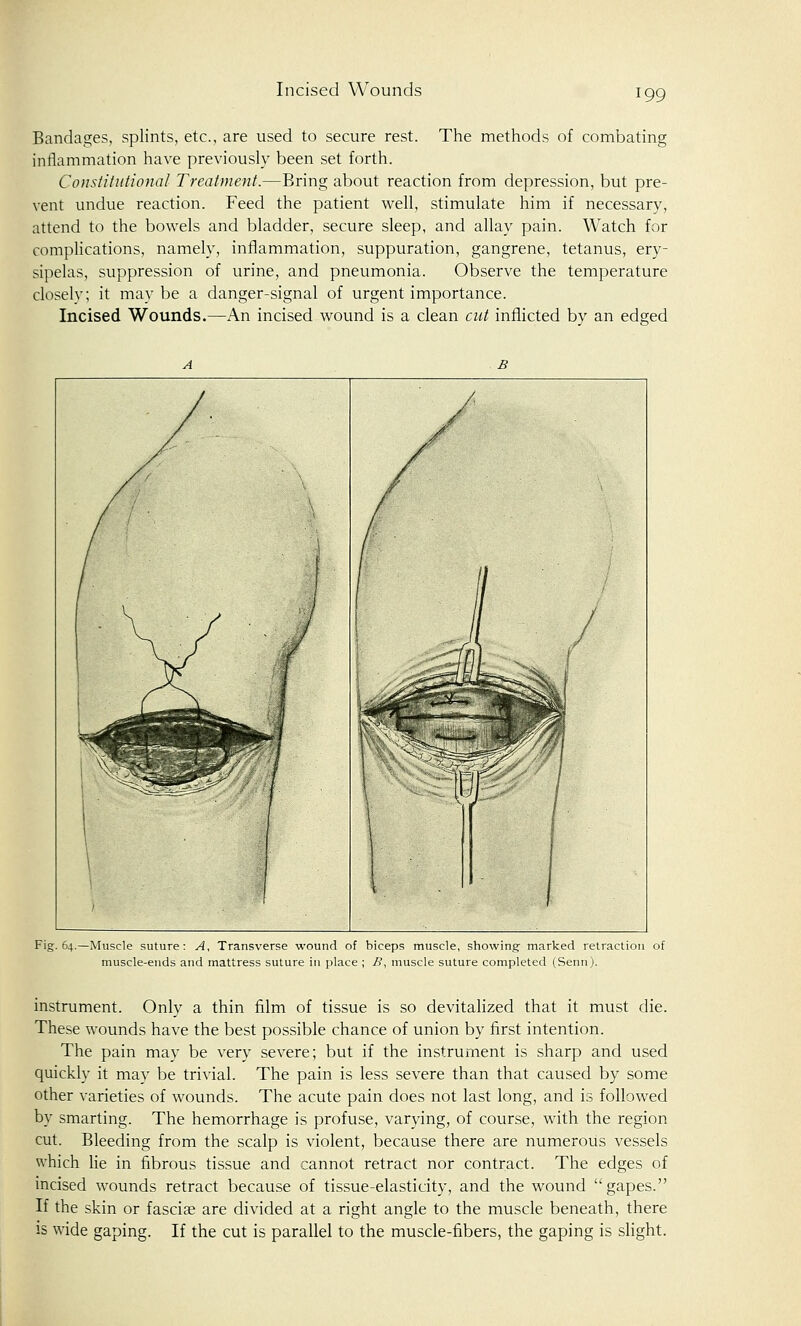Bandages, splints, etc., are used to secure rest. The methods of combating inflammation have previously been set forth. Constitutional Treatment.—Bring about reaction from depression, but pre- vent undue reaction. Feed the patient well, stimulate him if necessary, attend to the bowels and bladder, secure sleep, and allay pain. Watch for complications, namely, inflammation, suppuration, gangrene, tetanus, ery- sipelas, suppression of urine, and pneumonia. Observe the temperature closely; it may be a danger-signal of urgent importance. Incised Wounds.—An incised wound is a clean cut inflicted by an edged Fig. 64.—Muscle suture: A, Transverse wound of biceps muscle, showing marked retraction of muscle-ends and mattress suture in place ; B, muscle suture completed (Senn). instrument. Only a thin film of tissue is so devitalized that it must die. These wounds have the best possible chance of union by first intention. The pain may be very severe; but if the instrument is sharp and used quickly it may be trivial. The pain is less severe than that caused by some other varieties of wounds. The acute pain does not last long, and is followed by smarting. The hemorrhage is profuse, varying, of course, with the region cut. Bleeding from the scalp is violent, because there are numerous vessels which lie in fibrous tissue and cannot retract nor contract. The edges of incised wounds retract because of tissue-elasticity, and the wound gapes. If the skin or fasciae are divided at a right angle to the muscle beneath, there is wide gaping. If the cut is parallel to the muscle-fibers, the gaping is slight.