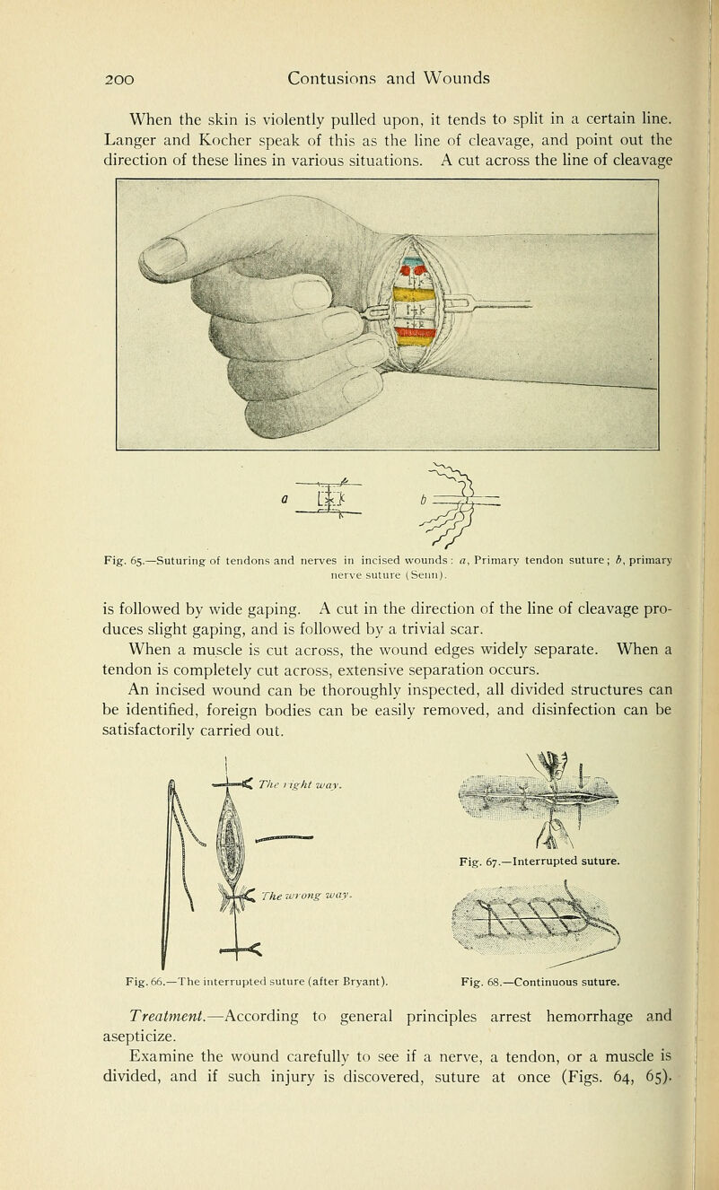When the skin is violently pulled upon, it tends to split in a certain line. Langer and Kocher speak of this as the line of cleavage, and point out the direction of these lines in various situations. A cut across the line of cleavage F=^ Fig. 65.—Suturing of tendons and nerves in incised wounds : a, Primary tendon suture; b, primary nerve suture (Senn). is followed by wide gaping. A cut in the direction of the line of cleavage pro- duces slight gaping, and is followed by a trivial scar. When a muscle is cut across, the wound edges widely separate. When a tendon is completely cut across, extensive separation occurs. An incised wound can be thoroughly inspected, all divided structures can be identified, foreign bodies can be easily removed, and disinfection can be satisfactorily carried out. The right way. iM-fQ The wrong way, Fig. 66.—The interrupted suture (after Bryant). Fig. 67.—Interrupted suture. 3? Fig. 68.—Continuous suture. Treatment.—According to general principles arrest hemorrhage and asepticize. Examine the wound carefully to see if a nerve, a tendon, or a muscle is divided, and if such injury is discovered, suture at once (Figs. 64, 65).