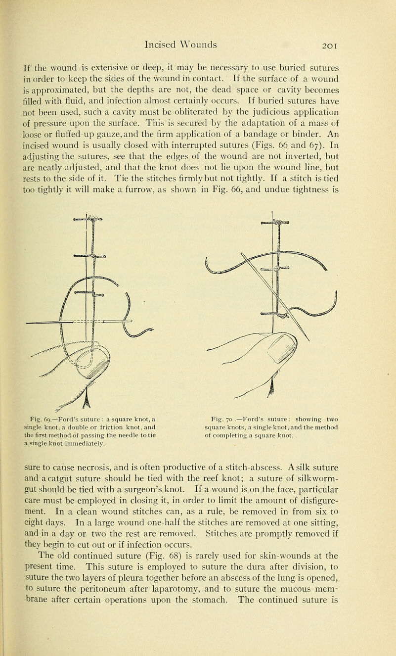 If the wound is extensive or deep, it may be necessary to use buried sutures in order to keep the sides of the wound in contact. If the surface of a wound is approximated, but the depths are not, the dead space or cavity becomes filled with fluid, and infection almost certainly occurs. If buried sutures have not been used, such a cavity must be obliterated by the judicious application of pressure upon the surface. This is secured by the adaptation of a mass of loose or fluffed-up gauze, and the firm application of a bandage or binder. An incised wound is usually closed with interrupted sutures (Figs. 66 and 67). In adjusting the sutures, see that the edges of the wound are not inverted, but are neatly adjusted, and that the knot does not lie upon the wound line, but rests to the side of it. Tie the stitches firmly but not tightly. If a stitch is tied too tightly it will make a furrow, as shown in Fig. 66, and undue tightness is Fig. 69.—Ford's suture : a square knot, a single knot, a double or friction knot, and the first method of passing the needle to tie a single knot immediately. Fig. 70 .—Ford's suture : showing two square knots, a single knot, and the method of completing a square knot. sure to cause necrosis, and is often productive of a stitch-abscess. A silk suture and a catgut suture should be tied with the reef knot; a suture of silkworm- gut should be tied with a surgeon's knot. If a wound is on the face, particular care must be employed in closing it, in order to limit the amount of disfigure- ment. In a clean wound stitches can, as a rule, be removed in from six to eight days. In a large wound one-half the stitches are removed at one sitting, and in a day or two the rest are removed. Stitches are promptly removed if they begin to cut out or if infection occurs. The old continued suture (Fig. 68) is rarely used for skin-wounds at the present time. This suture is employed to suture the dura after division, to suture the two layers of pleura together before an abscess of the lung is opened, to suture the peritoneum after laparotomy, and to suture the mucous mem- brane after certain operations upon the stomach. The continued suture is