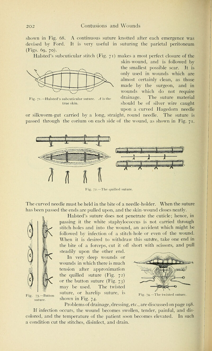 shown in Fig. 68. A continuous suture knotted after each emergence was devised by Ford. It is very useful in suturing the parietal peritoneum (Figs. 69, 70). Halsted's subcuticular stitch (Fig. 71) makes a most perfect closure of the skin-wound, and is followed by the smallest possible scar. It is only used in wounds which are almost certainly clean, as those made by the surgeon, and in wounds which do not require drainage. The suture material should be of silver wire caught upon a curved Hagedorn needle or silkworm-gut carried by a long, straight, round needle. The suture is passed through the corium on each side of the wound, as shown in Fig. 71. Fig. 71.—Halsted's subcuticular suture. A is the true skin. Fig. 72.—The quilled suture. The curved needle must be held in the bite of a needle-holder. When the suture has been passed the ends are pulled upon, and the skin-wound closes neatly. Halsted's suture does not penetrate the cuticle; hence, in passing it the white staphylococcus is not carried through stitch-holes and into the wound, an accident which might be followed by infection of a stitch-hole or even of the wound. When it is desired to withdraw this suture, take one end in the bite of a forceps, cut it off short with scissors, and pull steadily upon the other end. In very deep wounds or wounds in which there is much tension after approximation the quilled suture (Fig. 72) or the button suture (Fig. 73) may be used. The twisted suture, or harelip suture, is shown in Fig. 74. Problems of drainage, dressing, etc., are discussed on page 198. If infection occurs, the wound becomes swollen, tender, painful, and dis- colored, and the temperature of the patient soon becomes elevated. In such a condition cut the stitches, disinfect, and drain. Fig. 73.—Button suture. The twisted suture.