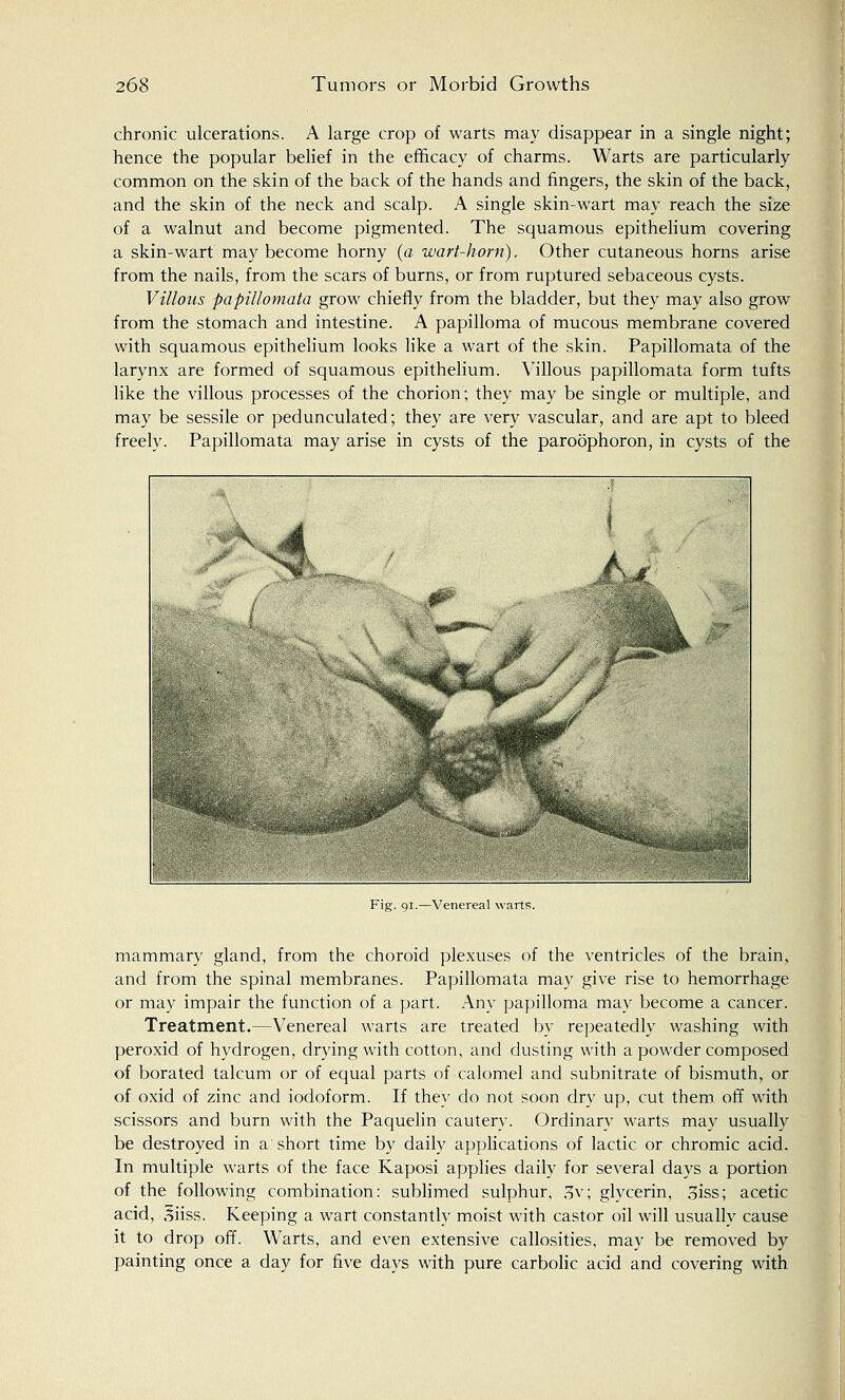 chronic ulcerations. A large crop of warts may disappear in a single night; hence the popular belief in the efficacy of charms. Warts are particularly common on the skin of the back of the hands and fingers, the skin of the back, and the skin of the neck and scalp. A single skin-wart may reach the size of a walnut and become pigmented. The squamous epithelium covering a skin-wart may become horny (a wart-horn). Other cutaneous horns arise from the nails, from the scars of burns, or from ruptured sebaceous cysts. Villous papillomata grow chiefly from the bladder, but they may also grow from the stomach and intestine. A papilloma of mucous membrane covered with squamous epithelium looks like a wart of the skin. Papillomata of the larynx are formed of squamous epithelium. Villous papillomata form tufts like the villous processes of the chorion; they may be single or multiple, and may be sessile or pedunculated; they are very vascular, and are apt to bleed freely. Papillomata may arise in cysts of the paroophoron, in cysts of the Fig. 91.—Venereal warts. mammary gland, from the choroid plexuses of the ventricles of the brain, and from the spinal membranes. Papillomata may give rise to hemorrhage or may impair the function of a part. Any papilloma may become a cancer. Treatment.—Venereal warts are treated by repeatedly washing with peroxid of hydrogen, drying with cotton, and dusting with a powder composed of borated talcum or of equal parts of calomel and subnitrate of bismuth, or of oxid of zinc and iodoform. If they do not soon dry up, cut them off with scissors and burn with the Paquelin cautery. Ordinary warts may usually be destroyed in a short time by daily applications of lactic or chromic acid. In multiple warts of the face Kaposi applies daily for several days a portion of the following combination: sublimed sulphur, 3v; glycerin, 3iss; acetic acid, 5iiss. Keeping a wart constantly moist with castor oil will usually cause it to drop off. Warts, and even extensive callosities, may be removed by painting once a day for five days with pure carbolic acid and covering with