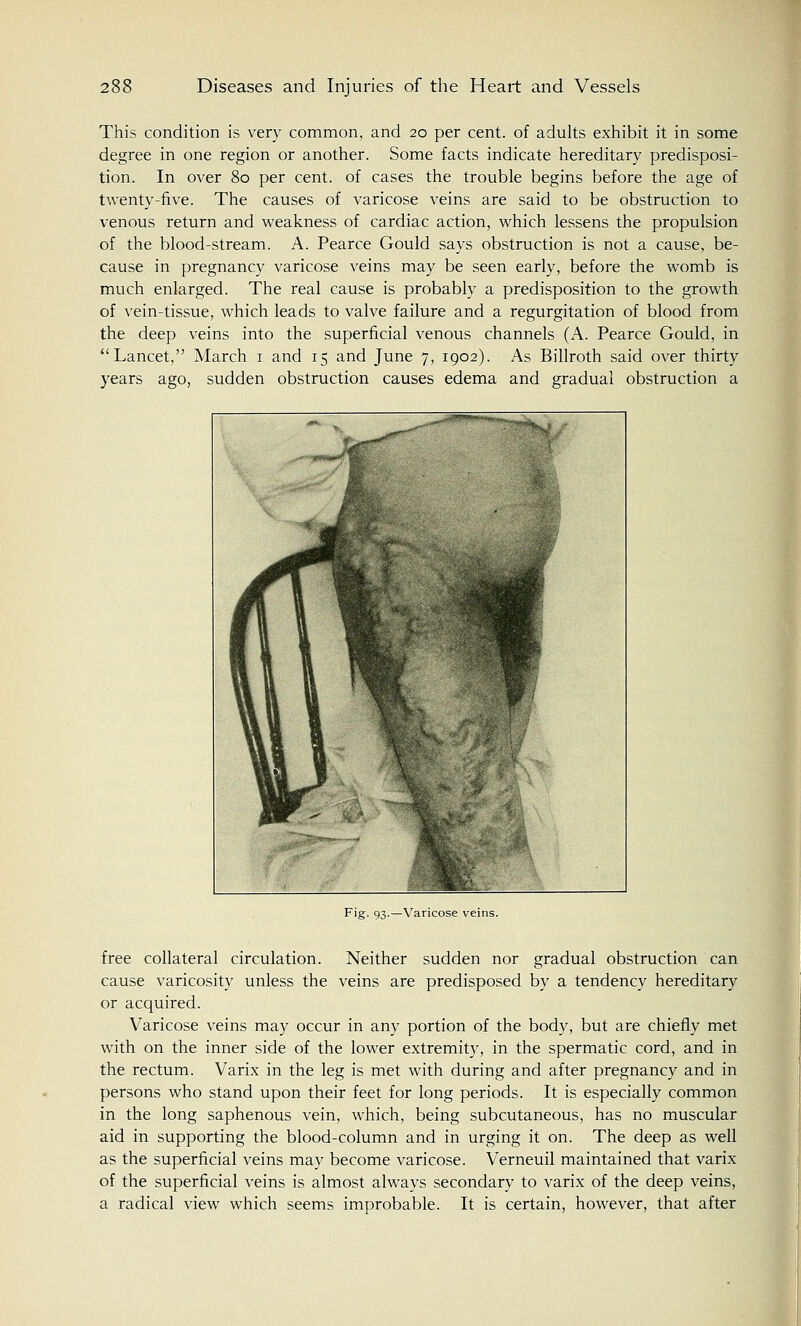 This condition is very common, and 20 per cent, of adults exhibit it in some degree in one region or another. Some facts indicate hereditary predisposi- tion. In over 80 per cent, of cases the trouble begins before the age of twenty-five. The causes of varicose veins are said to be obstruction to venous return and weakness of cardiac action, which lessens the propulsion of the blood-stream. A. Pearce Gould says obstruction is not a cause, be- cause in pregnancy varicose veins may be seen early, before the womb is much enlarged. The real cause is probably a predisposition to the growth of vein-tissue, which leads to valve failure and a regurgitation of blood from the deep veins into the superficial venous channels (A. Pearce Gould, in Lancet, March 1 and 15 and June 7, 1902). As Billroth said over thirty years ago, sudden obstruction causes edema and gradual obstruction a Fig. 93.—Varicose veins. free collateral circulation. Neither sudden nor gradual obstruction can cause varicosity unless the veins are predisposed by a tendency hereditary or acquired. Varicose veins may occur in any portion of the body, but are chiefly met with on the inner side of the lower extremity, in the spermatic cord, and in the rectum. Varix in the leg is met with during and after pregnancy and in persons who stand upon their feet for long periods. It is especially common in the long saphenous vein, which, being subcutaneous, has no muscular aid in supporting the blood-column and in urging it on. The deep as well as the superficial veins may become varicose. Verneuil maintained that varix of the superficial veins is almost always secondary to varix of the deep veins, a radical view which seems improbable. It is certain, however, that after