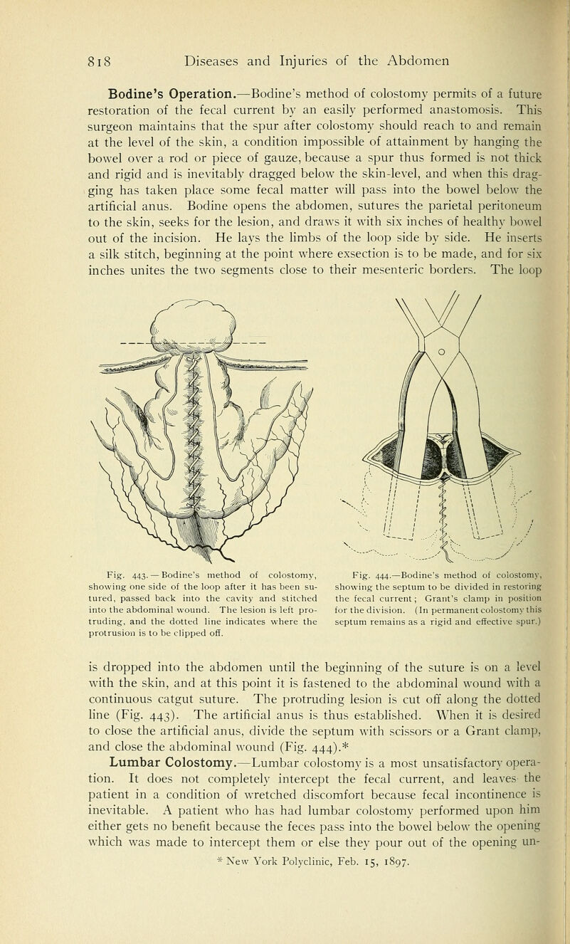 Bodine's Operation.—Bodine's method of colostomy permits of a future restoration of the fecal current by an easily performed anastomosis. This surgeon maintains that the spur after colostomy should reach to and remain at the level of the skin, a condition impossible of attainment by hanging the bowel over a rod or piece of gauze, because a spur thus formed is not thick and rigid and is inevitably dragged below the skin-level, and when this drag- ging has taken place some fecal matter will pass into the bowel below the artificial anus. Bodine opens the abdomen, sutures the parietal peritoneum to the skin, seeks for the lesion, and draws it with six inches of healthy bowel out of the incision. He lays the limbs of the loop side by side. He inserts a silk stitch, beginning at the point where exsection is to be made, and for six inches unites the two segments close to their mesenteric borders. The loop Fig. 443. — Bodine's method of colostomy, showing one side of the loop after it has been su- tured, passed back into the cavity and stitched into the abdominal wound. The lesion is left pro- truding, and the dotted line indicates where the protrusion is to be clipped off. Fig. 444.—Bodine's method of colostomy, showing the septum to be divided in restoring the fecal current; Grant's clamp in position for the division. (In permanent colostomy this septum remains as a rigid and effective spur.) is dropped into the abdomen until the beginning of the suture is on a level with the skin, and at this point it is fastened to the abdominal wound with a continuous catgut suture. The protruding lesion is cut off along the dotted line (Fig. 443). The artificial anus is thus established. When it is desired to close the artificial anus, divide the septum with scissors or a Grant clamp, and close the abdominal wound (Fig. 444).* Lumbar Colostomy.—Lumbar colostomy is a most unsatisfactory opera- tion. It does not completely intercept the fecal current, and leaves the patient in a condition of wretched discomfort because fecal incontinence is inevitable. A patient who has had lumbar colostomy performed upon him either gets no benefit because the feces pass into the bowel below the opening which was made to intercept them or else they pour out of the opening un- * New York Polyclinic, Feb. 15, 1897.