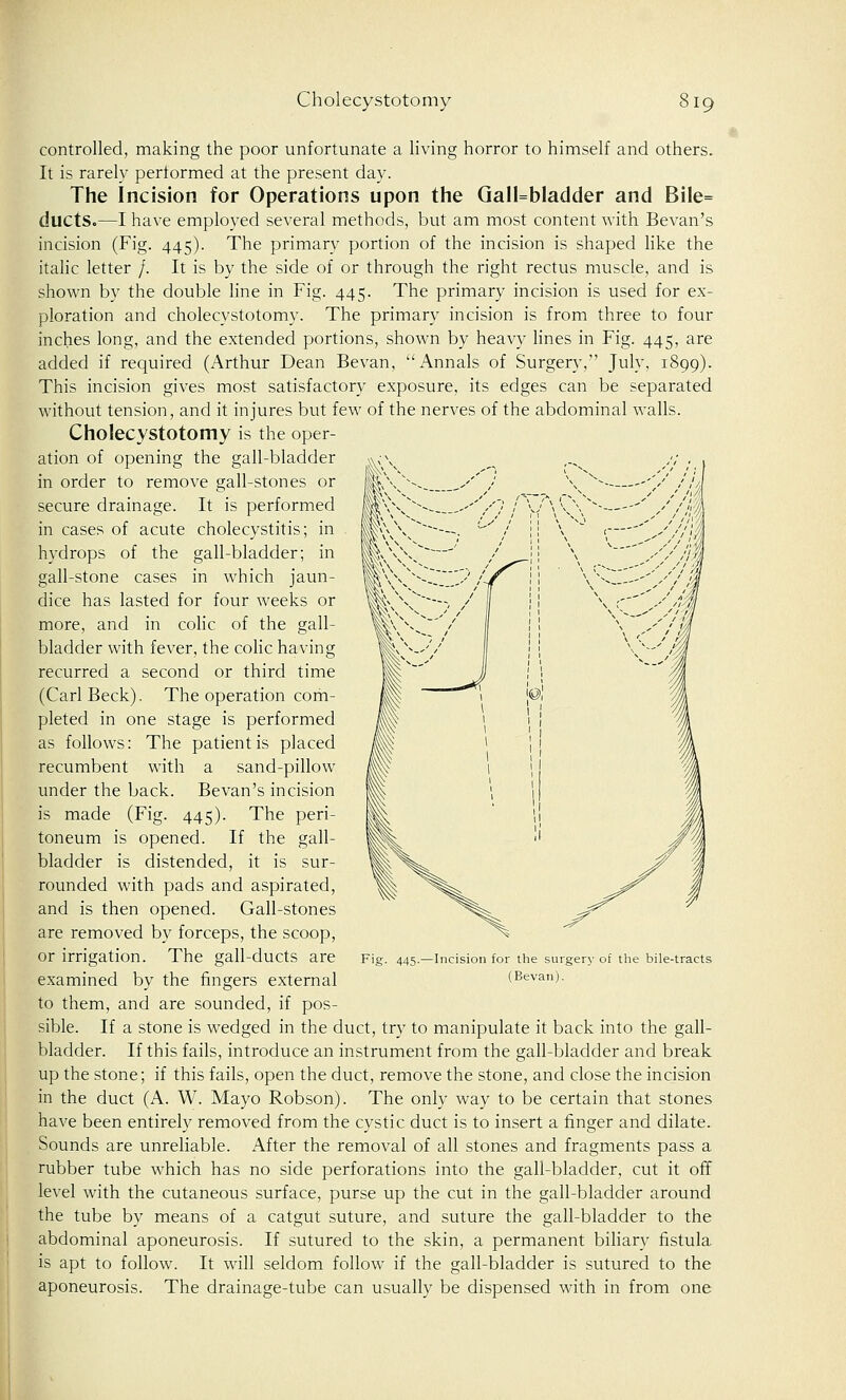 controlled, making the poor unfortunate a living horror to himself and others. It is rarely performed at the present day. The Incision for Operations upon the Gall=bladder and Bile= ducts.—I have employed several methods, but am most content with Bevan's incision (Fig. 445). The primary portion of the incision is shaped like the italic letter /. It is by the side of or through the right rectus muscle, and is shown by the double line in Fig. 445. The primary incision is used for ex- ploration and cholecystotomy. The primary incision is from three to four inches long, and the extended portions, shown by heavy lines in Fig. 445, are added if required (Arthur Dean Bevan, Annals of Surgery, July, 1899). This incision gives most satisfactory exposure, its edges can be separated without tension, and it injures but few of the nerves of the abdominal walls. Cholecystotomy is the oper- ation of opening the gall-bladder in order to remove gall-stones or secure drainage. It is performed in cases of acute cholecystitis; in hydrops of the gall-bladder; in gall-stone cases in which jaun- dice has lasted for four weeks or more, and in colic of the gall- bladder with fever, the colic having recurred a second or third time (Carl Beck). The operation com- pleted in one stage is performed as follows: The patient is placed recumbent with a sand-pillow under the back. Bevan's incision is made (Fig. 445). The peri- toneum is opened. If the gall- bladder is distended, it is sur- rounded with pads and aspirated, and is then opened. Gall-stones are removed by forceps, the scoop, or irrigation. The gall-ducts are examined by the fingers external to them, and are sounded, if pos- sible. If a stone is wedged in the duct, try to manipulate it back into the gall- bladder. If this fails, introduce an instrument from the gall-bladder and break up the stone; if this fails, open the duct, remove the stone, and close the incision in the duct (A. W. Mayo Robson). The only way to be certain that stones have been entirely removed from the cystic duct is to insert a finger and dilate. Sounds are unreliable. After the removal of all stones and fragments pass a rubber tube which has no side perforations into the gall-bladder, cut it off level with the cutaneous surface, purse up the cut in the gall-bladder around the tube by means of a catgut suture, and suture the gall-bladder to the abdominal aponeurosis. If sutured to the skin, a permanent biliary fistula is apt to follow. It will seldom follow if the gall-bladder is sutured to the aponeurosis. The drainage-tube can usually be dispensed with in from one 445.—Incision for the surgery of the bile-tracts (Bevan).