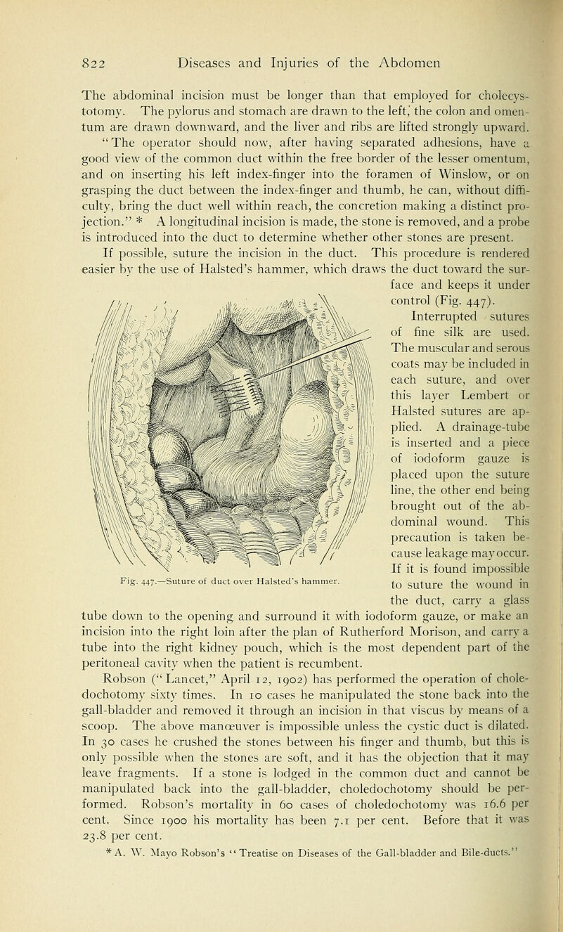 The abdominal incision must be longer than that employed for cholecys- totomy. The pylorus and stomach are drawn to the left,' the colon and omen- tum are drawn downward, and the liver and ribs are lifted strongly upward. The operator should now, after having separated adhesions, have a good view of the common duct within the free border of the lesser omentum, and on inserting his left index-finger into the foramen of Winslow, or on grasping the duct between the index-finger and thumb, he can, without diffi- culty, bring the duct well within reach, the concretion making a distinct pro- jection. * A longitudinal incision is made, the stone is removed, and a probe is introduced into the duct to determine whether other stones are present. If possible, suture the incision in the duct. This procedure is rendered easier by the use of Halsted's hammer, which draws the duct toward the sur- face and keeps it under control (Fig. 447). Interrupted sutures of fine silk are used. The muscular and serous coats may be included in each suture, and over this layer Lembert or Halsted sutures are ap- plied. A drainage-tube is inserted and a piece of iodoform gauze is placed upon the suture line, the other end being brought out of the ab- dominal wound. This precaution is taken be- cause leakage may occur. If it is found impossible to suture the wound in the duct, carry a glass tube down to the opening and surround it with iodoform gauze, or make an incision into the right loin after the plan of Rutherford Morison, and carry a tube into the right kidney pouch, which is the most dependent part of the peritoneal cavity when the patient is recumbent. Robson (Lancet, April 12, 1902) has performed the operation of chole- dochotomy sixty times. In 10 cases he manipulated the stone back into the gall-bladder and removed it through an incision in that viscus by means of a scoop. The above manceuver is impossible unless the cystic duct is dilated. In 30 cases he crushed the stones between his finger and thumb, but this is only possible when the stones are soft, and it has the objection that it may leave fragments. If a stone is lodged in the common duct and cannot be manipulated back into the gall-bladder, choledochotomy should be per- formed. Robson's mortality in 60 cases of choledochotomy was 16.6 per cent. Since 1900 his mortality has been 7.1 per cent. Before that it was 23.8 per cent. *A. W. Mayo Robson's Treatise on Diseases of the Gall-bladder and Bile-ducts. 447.—Suture of duct over Halsted's hammer.