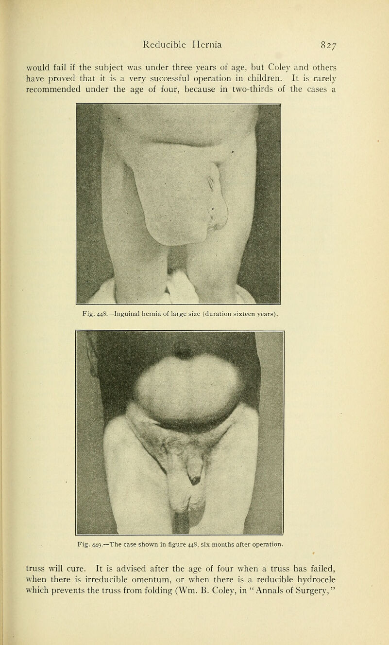 would fail if the subject was under three years of age, but Coley and others have proved that it is a very successful operation in children. It is rarely recommended under the age of four, because in two-thirds of the cases a Fig. 448.—Inguinal hernia of large size (duration sixteen years). Fig. 449.—The case shown in figure 448, six months after operation. truss will cure. It is advised after the age of four when a truss has failed, when there is irreducible omentum, or when there is a reducible hydrocele which prevents the truss from folding (Wm. B. Coley, in  Annals of Surgery,