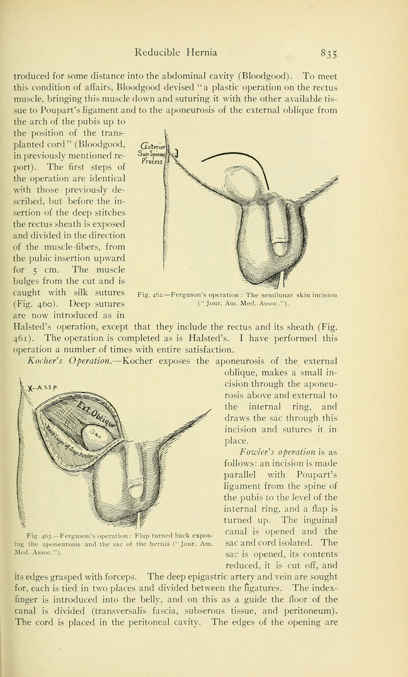 Gntenor SuK>.Spmou5 Process Fig. 462.—Ferguson's operation : The semilunar skin incision ( Jour. Am. Med. Assoc). troduced for some distance into the abdominal cavity (Bloodgood). To meet this condition of affairs, Bloodgood devised a plastic operation on the rectus muscle, bringing this muscle down and suturing it with the other available tis- sue to Poupart's ligament and to the aponeurosis of the external oblique from the arch of the pubis up to the position of the trans- planted cord  (Bloodgood, in previously mentioned re- port). The first steps of the operation are identical with those previously de- scribed, but before the in- sertion of the deep stitches the rectus sheath is exposed and divided in the direction of the muscle-fibers, from the pubic insertion upward for 5 cm. The muscle bulges from the cut and is caught with silk sutures (Fig. 460). Deep sutures are now introduced as in Halsted's operation, except that they include the rectus and its sheath (Fig. 461). The operation is completed as is Halsted's. I have performed this operation a number of times with entire satisfaction. Rocker's Operation.—Kocher exposes the aponeurosis of the external oblique, makes a small in- cision through the aponeu- rosis above and external to the internal ring, and draws the sac through this incision and sutures it in place. Fowler's operation is as follows: an incision is made parallel with Poupart's ligament from the spine of the pubis to the level of the internal ring, and a flap is turned up. The inguinal canal is opened and the sac and cord isolated. The sac is opened, its contents reduced, it is cut off, and its edges grasped with forceps. The deep epigastric artery and vein are sought for, each is tied in two places and divided between the ligatures. The index- finger is introduced into the belly, and on this as a guide the floor of the canal is divided (transversalis fascia, subserous tissue, and peritoneum). The cord is placed in the peritoneal cavity. The edges of the opening are uX-A.s.sp Fig. 463.—Ferguson's operation : Flap turned back expos ing the aponeurosis and the sac of the hernia (Jour. Am Med. Assoc).