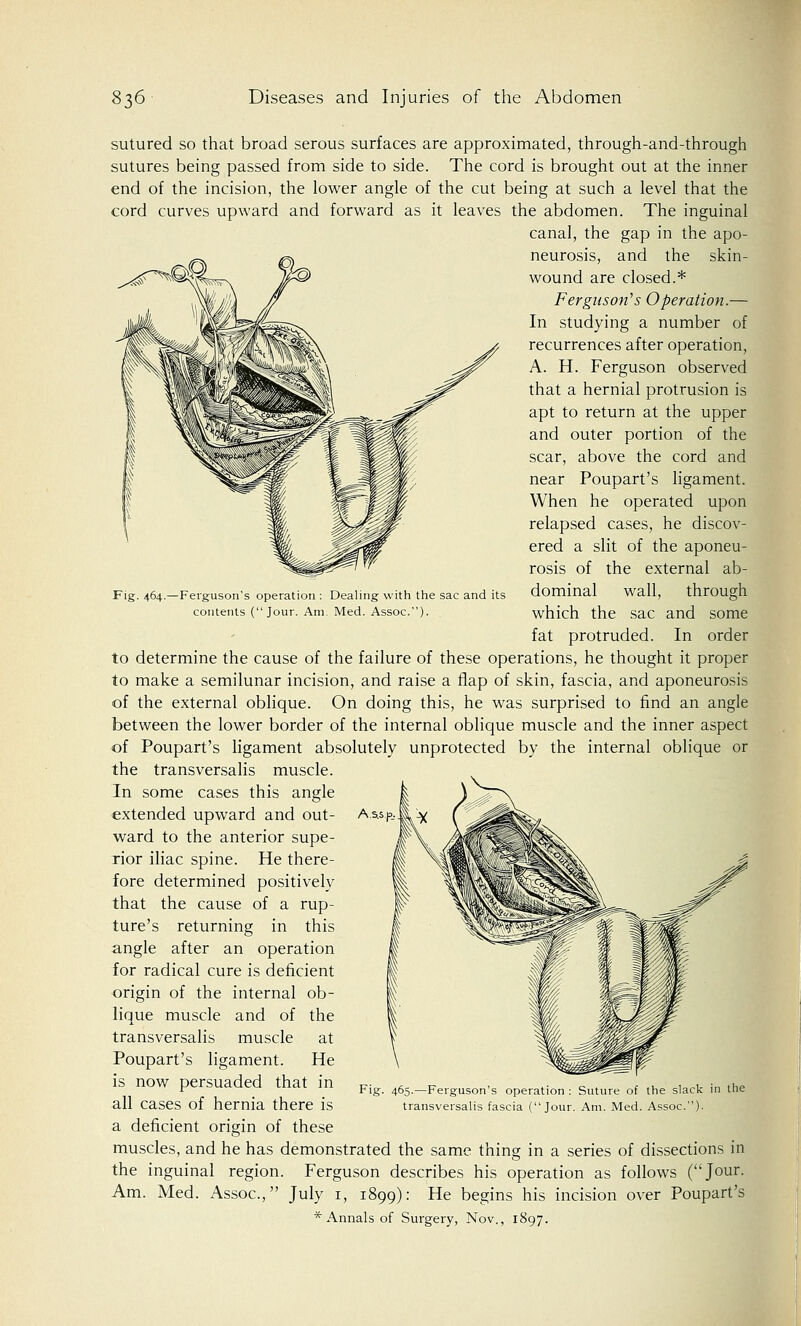 Fig. 464.—Ferguson's operation : Dealing with the sac and its contents (Jour. Am. Med. Assoc). sutured so that broad serous surfaces are approximated, through-and-through sutures being passed from side to side. The cord is brought out at the inner end of the incision, the lower angle of the cut being at such a level that the cord curves upward and forward as it leaves the abdomen. The inguinal canal, the gap in the apo- neurosis, and the skin- wound are closed.* Ferguson's Operation.— In studying a number of recurrences after operation, A. H. Ferguson observed that a hernial protrusion is apt to return at the upper and outer portion of the scar, above the cord and near Poupart's ligament. When he operated upon relapsed cases, he discov- ered a slit of the aponeu- rosis of the external ab- dominal wall, through which the sac and some fat protruded. In order to determine the cause of the failure of these operations, he thought it proper to make a semilunar incision, and raise a flap of skin, fascia, and aponeurosis of the external oblique. On doing this, he was surprised to find an angle between the lower border of the internal oblique muscle and the inner aspect of Poupart's ligament absolutely unprotected by the internal oblique or the transversalis muscle. In some cases this angle extended upward and out- ward to the anterior supe- rior iliac spine. He there- fore determined positively that the cause of a rup- ture's returning in this angle after an operation for radical cure is deficient origin of the internal ob- lique muscle and of the transversalis muscle at Poupart's ligament. He is now persuaded that in all cases of hernia there is a deficient origin of these muscles, and he has demonstrated the same thing in a series of dissections in the inguinal region. Ferguson describes his operation as follows (Jour. Am. Med. Assoc, July 1, 1899): He begins his incision over Poupart's * Annals of Surgery, Nov., 1897. A.s.sp_. Fig. 465.—Ferguson's operation : Suture of the slack in the transversalis fascia (Jour. Am. Med. Assoc).