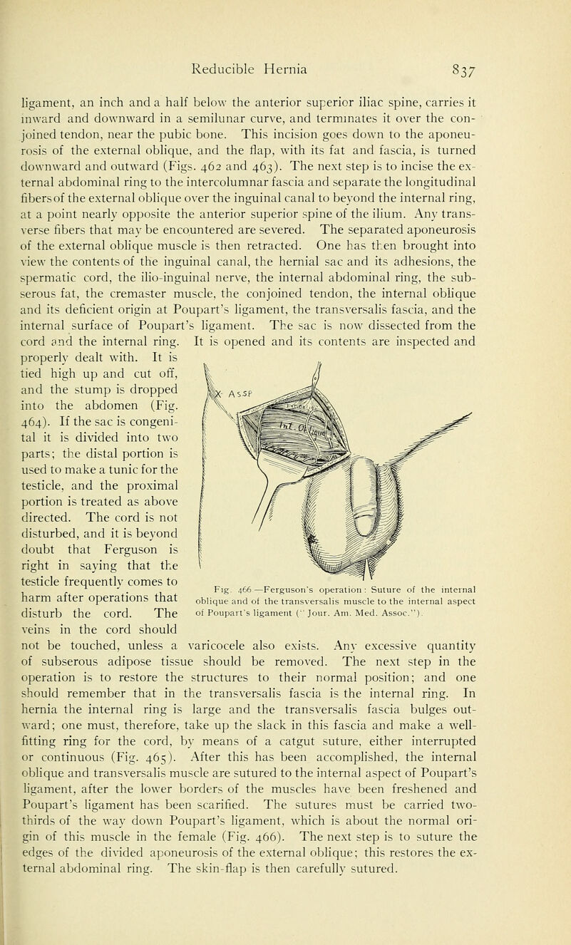 ligament, an inch and a half below the anterior superior iliac spine, carries it inward and downward in a semilunar curve, and terminates it over the con- joined tendon, near the pubic bone. This incision goes down to the aponeu- rosis of the external oblique, and the flap, with its fat and fascia, is turned downward and outward (Figs. 462 and 463). The next step is to incise the ex- ternal abdominal ring to the intercolumnar fascia and separate the longitudinal fibers of the external oblique over the inguinal canal to beyond the internal ring, at a point nearly opposite the anterior superior spine of the ilium. Any trans- verse fibers that may be encountered are severed. The separated aponeurosis of the external oblique muscle is then retracted. One has then brought into view the contents of the inguinal canal, the hernial sac and its adhesions, the spermatic cord, the ilio-inguinal nerve, the internal abdominal ring, the sub- serous fat, the cremaster muscle, the conjoined tendon, the internal oblique and its deficient origin at Poupart's ligament, the transversalis fascia, and the internal surface of Poupart's ligament. The sac is now dissected from the cord and the internal ring. It is opened and its contents are inspected and properly dealt with. It is tied high up and cut off, and the stump is dropped into the abdomen (Fig. 464). If the sac is congeni- tal it is divided into two parts; the distal portion is used to make a tunic for the testicle, and the proximal portion is treated as above directed. The cord is not disturbed, and it is beyond doubt that Ferguson is right in saying that the testicle frequently comes to harm after operations that disturb the cord. The veins in the cord should not be touched, unless a varicocele also exists. Any excessive quantity of subserous adipose tissue should be removed. The next step in the operation is to restore the structures to their normal position; and one should remember that in the transversalis fascia is the internal ring. In hernia the internal ring is large and the transversalis fascia bulges out- ward; one must, therefore, take up the slack in this fascia and make a well- fitting ring for the cord, by means of a catgut suture, either interrupted or continuous (Fig. 465). After this has been accomplished, the internal oblique and transversalis muscle are sutured to the internal aspect of Poupart's ligament, after the lower borders of the muscles have been freshened and Poupart's ligament has been scarified. The sutures must be carried two- thirds of the way down Poupart's ligament, which is about the normal ori- gin of this muscle in the female (Fig. 466). The next step is to suture the edges of the divided aponeurosis of the external oblique; this restores the ex- ternal abdominal ring. The skin-flap is then carefully sutured. Fig. 466—Ferguson's operation: Suture of the internal oblique and of the transversalis muscle to the internal aspect of Poupart's ligament ( Jour. Am. Med. Assoc).