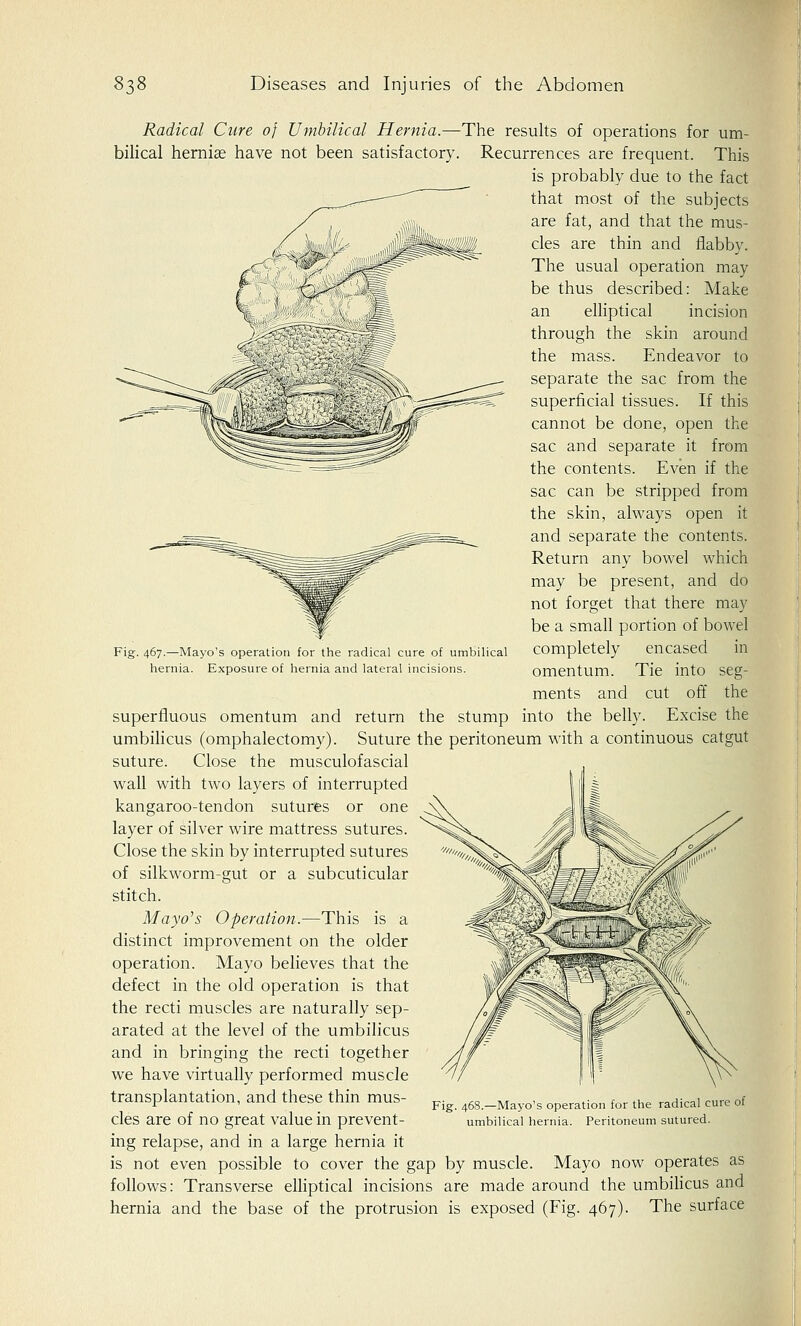Radical Cure of Umbilical Hernia.—The results of operations for um- bilical herniae have not been satisfactory. Recurrences are frequent. This is probably due to the fact that most of the subjects are fat, and that the mus- cles are thin and flabby. The usual operation may be thus described: Make an elliptical incision through the skin around the mass. Endeavor to separate the sac from the superficial tissues. If this cannot be done, open the sac and separate it from the contents. Even if the sac can be stripped from the skin, always open it and separate the contents. Return any bowel which may be present, and do not forget that there may be a small portion of bowel completely encased in omentum. Tie into seg- ments and cut off the superfluous omentum and return the stump into the belly. Excise the umbilicus (omphalectomy). Suture the peritoneum with a continuous catgut suture. Close the musculofascial wall with two layers of interrupted kangaroo-tendon sutures or one layer of silver wire mattress sutures. Close the skin by interrupted sutures of silkworm-gut or a subcuticular stitch. Mayo's Operation.—This is a distinct improvement on the older operation. Mayo believes that the defect in the old operation is that the recti muscles are naturally sep- arated at the level of the umbilicus and in bringing the recti together we have virtually performed muscle transplantation, and these thin mus- cles are of no great value in prevent- ing relapse, and in a large hernia it is not even possible to cover the gap by muscle. Mayo now operates as follows: Transverse elliptical incisions are made around the umbilicus and hernia and the base of the protrusion is exposed (Fig. 467). The surface Fig. 467.—Mayo's operation for the radical cure of umbilical hernia. Exposure of hernia and lateral incisions. Fig. 468.—Mayo's operation for the radical cure of umbilical hernia. Peritoneum sutured.