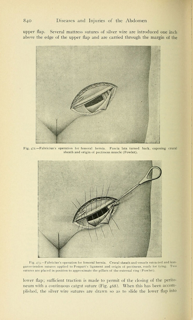 upper flap. Several mattress sutures of silver wire are introduced one inch above the edge of the upper flap and are carried through the margin of the Fig. 472.—Fabricius's operation for femoral hernia. Fascia lata turned back, exposing crural sheath and origin of pectineus muscle (Fowler). Fig- 473-—Fabricius's operation for femoral hernia. Crural sheath and vessels retracted and kan- garoo-tendon sutures applied to Poupart's ligament and origin of pectineus, ready for tying. Two sutures are placed in position to approximate the pillars of the external ring (Fowler). lower flap; sufficient traction is made to permit of the closing of the perito- neum with a continuous catgut suture (Fig. 468). When this has been accom- plished, the silver wire sutures are drawn so as to slide the lower flap into