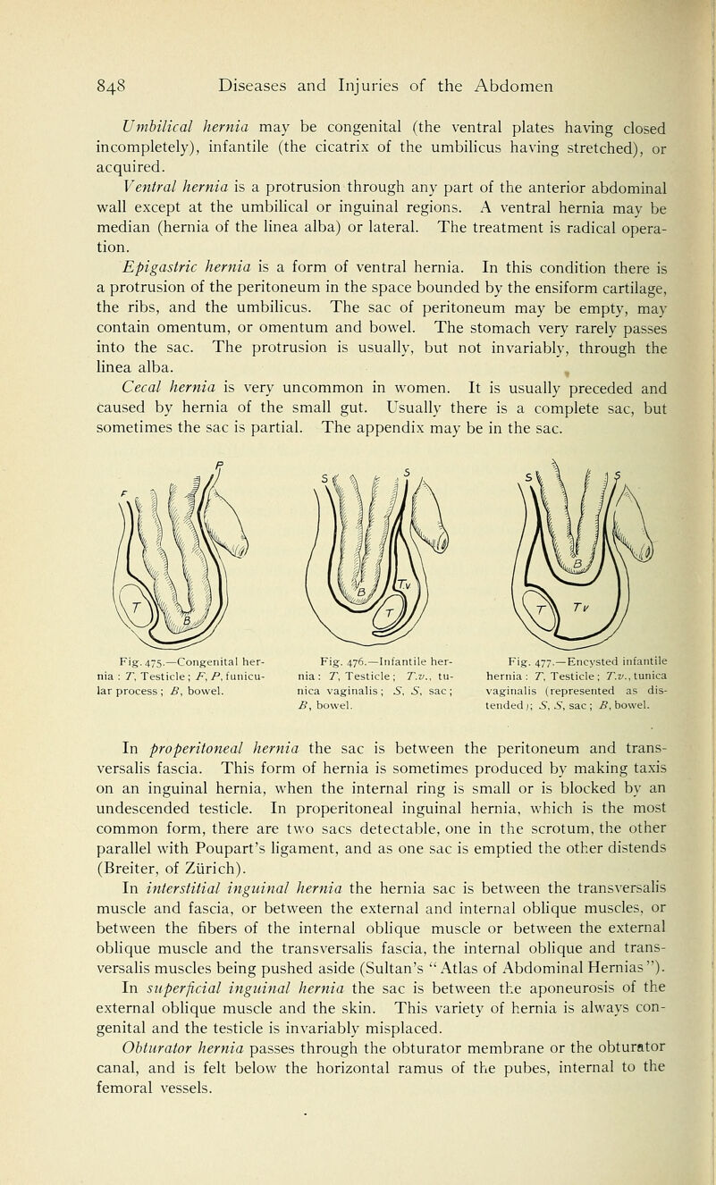 Umbilical hernia may be congenital (the ventral plates having closed incompletely), infantile (the cicatrix of the umbilicus having stretched), or acquired. Ventral hernia is a protrusion through any part of the anterior abdominal wall except at the umbilical or inguinal regions. A ventral hernia may be median (hernia of the linea alba) or lateral. The treatment is radical opera- tion. Epigastric hernia is a form of ventral hernia. In this condition there is a protrusion of the peritoneum in the space bounded by the ensiform cartilage, the ribs, and the umbilicus. The sac of peritoneum may be empty, may contain omentum, or omentum and bowel. The stomach very rarely passes into the sac. The protrusion is usually, but not invariably, through the linea alba. Cecal hernia is very uncommon in women. It is usually preceded and caused by hernia of the small gut. Usually there is a complete sac, but sometimes the sac is partial. The appendix may be in the sac. Fig. 475.—Congenital her- nia : T, Testicle ; F, P, funicu- lar process ; B% bowel. Fig. 476.—Infantile her- nia : T, Testicle ; T.v., tu- nica vaginalis ; .S, S, sac ; B, bowel. Fig. 477.—Encysted infantile hernia: T, Testicle ; T.v., tunica vaginalis (represented as dis- tended); S, 5, sac ; B, bowel. In preperitoneal hernia the sac is between the peritoneum and trans- versalis fascia. This form of hernia is sometimes produced by making taxis on an inguinal hernia, when the internal ring is small or is blocked by an undescended testicle. In preperitoneal inguinal hernia, which is the most common form, there are two sacs detectable, one in the scrotum, the other parallel with Poupart's ligament, and as one sac is emptied the other distends (Breiter, of Zurich). In interstitial inguinal hernia the hernia sac is between the transversalis muscle and fascia, or between the external and internal oblique muscles, or between the fibers of the internal oblique muscle or between the external oblique muscle and the transversalis fascia, the internal oblique and trans- versalis muscles being pushed aside (Sultan's ''Atlas of Abdominal Hernias). In superficial inguinal hernia the sac is between the aponeurosis of the external oblique muscle and the skin. This variety of hernia is always con- genital and the testicle is invariably misplaced. Obturator hernia passes through the obturator membrane or the obturator canal, and is felt below the horizontal ramus of the pubes, internal to the femoral vessels.