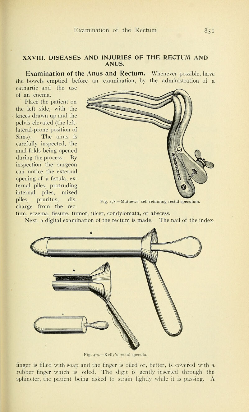 XXVIII. DISEASES AND INJURIES OF THE RECTUM AND ANUS. Examination of the Anus and Rectum.—Whenever possible, have the bowels emptied before an examination, by the administration of a cathartic and the use of an enema. Place the patient on the left side, with the knees drawn up and the pelvis elevated (the left- lateral-prone position of Sims). The anus is carefully inspected, the anal folds being opened during the process. By inspection the surgeon can notice the external opening of a fistula, ex- ternal piles, protruding internal piles, mixed piles, pruritus, dis- charge from the rec- tum, eczema, fissure, tumor, ulcer, condylomata, or abscess. Next, a digital examination of the rectum is made. The nail of the index- Fig. 478.—Mathews' self-retaining rectal speculum. 479.—Kelly's rectal specula. finger is filled with soap and the finger is oiled or, better, is covered with a rubber finger which is oiled. The digit is gently inserted through the sphincter, the patient being asked to strain lightly while it is passing. A