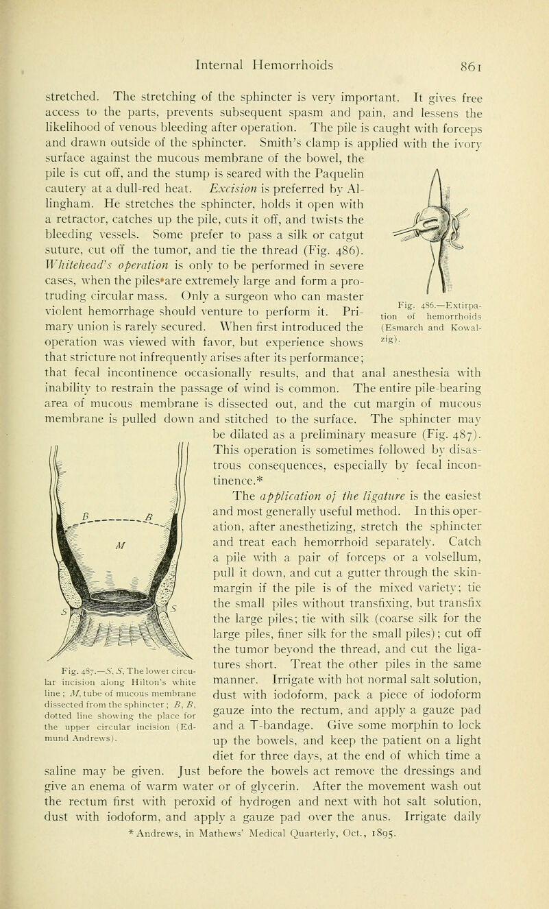 —E.xtirpa- hemorrhoids (Esmarch and Kowal- zig)- stretched. The stretching of the sphincter is very important. It gives free access to the parts, prevents subsequent spasm and pain, and lessens the likelihood of venous bleeding after operation. The pile is caught with forceps and drawn outside of the sphincter. Smith's clamp is applied with the ivory surface against the mucous membrane of the bowel, the pile is cut off, and the stump is seared with the Paquelin cautery at a dull-red heat. Excision is preferred by Al- lingham. He stretches the sphincter, holds it open with a retractor, catches up the pile, cuts it off, and twists the bleeding vessels. Some prefer to pass a silk or catgut suture, cut off the tumor, and tie the thread (Fig. 486). Whitehead's operation is only to be performed in severe cases, when the piles*are extremely large and form a pro- truding circular mass. Only a surgeon who can master violent hemorrhage should venture to perform it. Pri- mary union is rarely secured. When first introduced the operation was viewed with favor, but experience shows that stricture not infrequently arises after its performance; that fecal incontinence occasionally results, and that anal anesthesia with inability to restrain the passage of wind is common. The entire pile-bearing area of mucous membrane is dissected out, and the cut margin of mucous membrane is pulled down and stitched to the surface. The sphincter may be dilated as a preliminary measure (Fig. 487). This operation is sometimes followed by disas- trous consequences, especially by fecal incon- tinence.* The application of the ligature is the easiest and most generally useful method. In this oper- ation, after anesthetizing, stretch the sphincter and treat each hemorrhoid separately. Catch a pile with a pair of forceps or a volsellum, pull it down, and cut a gutter through the skin- margin if the pile is of the mixed variety; tie the small piles without transfixing, but transfix the large piles; tie with silk (coarse silk for the large piles, finer silk for the small piles); cut off the tumor beyond the thread, and cut the liga- tures short. Treat the other piles in the same manner. Irrigate with hot normal salt solution, dust with iodoform, pack a piece of iodoform gauze into the rectum, and apply a gauze pad and a T-bandage. Give some morphin to lock up the bowels, and keep the patient on a light diet for three days, at the end of which time a saline may be given. Just before the bowels act remove the dressings and give an enema of warm water or of glycerin. After the movement wash out the rectum first with peroxid of hydrogen and next with hot salt solution, dust with iodoform, and apply a gauze pad over the anus. Irrigate daily * Andrews, in Mathews' Medical Quarterly, Oct., 1895. Fig. 4S7.—.S, S, The lower circu- lar incision along Hilton's white line ; M. tube of mucous membrane dissected from the sphincter ; £, B, dotted line showing the place for the upper circular incision (Ed- mund Andrews).