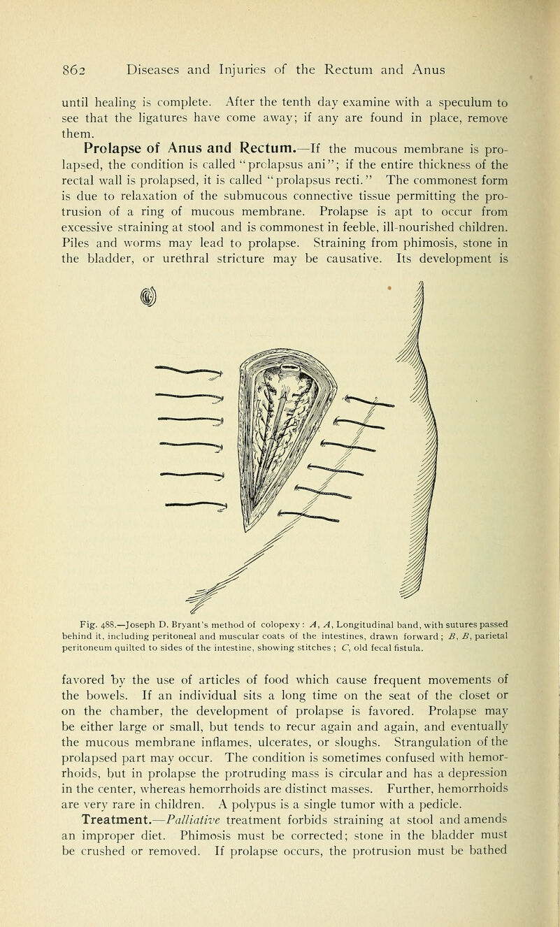 until healing is complete. After the tenth day examine with a speculum to see that the ligatures have come away; if any are found in place, remove them. Prolapse of Anus and Rectum.—If the mucous membrane is pro- lapsed, the condition is called prolapsus ani; if the entire thickness of the rectal wall is prolapsed, it is called prolapsus recti. The commonest form is due to relaxation of the submucous connective tissue permitting the pro- trusion of a ring of mucous membrane. Prolapse is apt to occur from excessive straining at stool and is commonest in feeble, ill-nourished children. Piles and worms may lead to prolapse. Straining from phimosis, stone in the bladder, or urethral stricture may be causative. Its development is Fig. 488.—Joseph D. Bryant's method of colopexy : A, A, Longitudinal band, with sutures passed behind it, including peritoneal and muscular coats of the intestines, drawn forward ; £, B, parietal peritoneum quilted to sides of the intestine, showing stitches ; C, old fecal fistula. favored by the use of articles of food which cause frequent movements of the bowels. If an individual sits a long time on the seat of the closet or on the chamber, the development of prolapse is favored. Prolapse may be either large or small, but tends to recur again and again, and eventually the mucous membrane inflames, ulcerates, or sloughs. Strangulation of the prolapsed part may occur. The condition is sometimes confused with hemor- rhoids, but in prolapse the protruding mass is circular and has a depression in the center, whereas hemorrhoids are distinct masses. Further, hemorrhoids are very rare in children. A polypus is a single tumor with a pedicle. Treatment.—Palliative treatment forbids straining at stool and amends an improper diet. Phimosis must be corrected; stone in the bladder must be crushed or removed. If prolapse occurs, the protrusion must be bathed