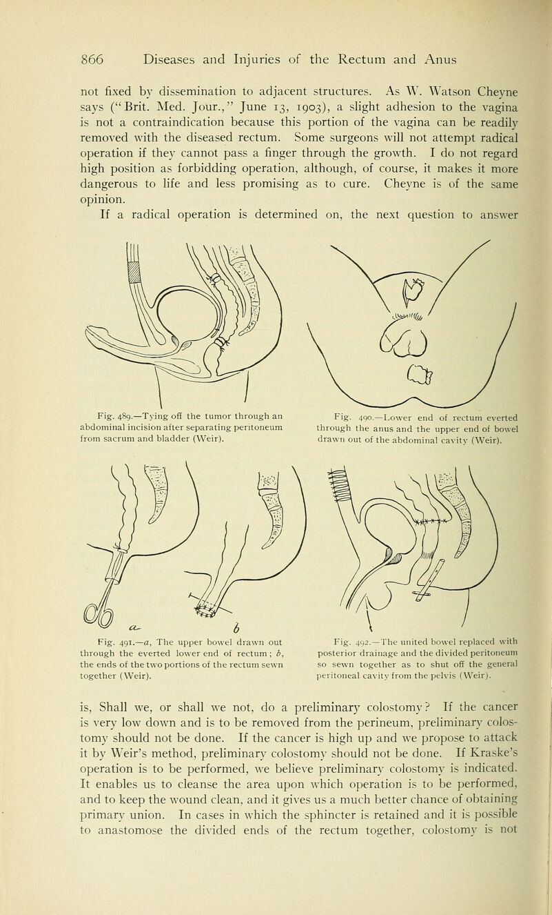 not fixed by dissemination to adjacent structures. As W. Watson Cheyne says (Brit. Med. Jour., June 13, 1903), a slight adhesion to the vagina is not a contraindication because this portion of the vagina can be readily removed with the diseased rectum. Some surgeons will not attempt radical operation if they cannot pass a finger through the growth. I do not regard high position as forbidding operation, although, of course, it makes it more dangerous to life and less promising as to cure. Cheyne is of the same opinion. If a radical operation is determined on, the next question to answer Fig. 489.—Tying off the tumor through an abdominal incision after separating peritoneum from sacrum and bladder (Weir). Fig. 490.—Lower end of rectum everted through the anus and the upper end of bowel drawn out of the abdominal cavity (Weir). Fig. 491.—a, The upper bowel drawn out through the everted lower end of rectum ; b, the ends of the two portions of the rectum sewn together (Weir). Fig. 492.—The united bowel replaced with posterior drainage and the divided peritoneum so sewn together as to shut off the general peritoneal cavity from the pelvis (Weir). is, Shall we, or shall we not, do a preliminary colostomy ? If the cancer is very low down and is to be removed from the perineum, preliminary colos- tomy should not be done. If the cancer is high up and we propose to attack it by Weir's method, preliminary colostomy should not be done. If Kraske's operation is to be performed, we believe preliminary colostomy is indicated. It enables us to cleanse the area upon which operation is to be performed, and to keep the wound clean, and it gives us a much better chance of obtaining primary union. In cases in which the sphincter is retained and it is possible to anastomose the divided ends of the rectum together, colostomy is not