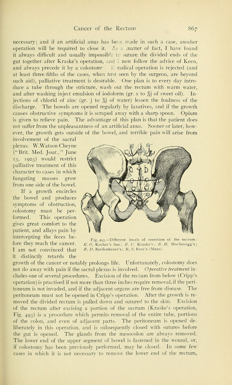necessary; and if an artificial anus has been made in such a case, another operation will be required to close it. As a matter of fact, I have found it always difficult and usually impossib'e to suture the divided ends of the gut together after Kraske's operation, and I now follow the advice of Keen, and always precede it by a colostoma If radical operation is rejected (and at least three-fifths of the cases, when first seen by the surgeon, are beyond such aid), palliative treatment is desirable. One plan is to every day intro- duce a tube through the stricture, wash out the rectum with warm water, and after washing inject emulsion of iodoform (gr. x to §j of sweet oil). In- jections of chlorid of zinc (gr. j to 5J of water) lessen the foulness of the discharge. The bowels are opened regularly by laxatives, and if the growth causes obstructive symptoms it is scraped away with a sharp spoon. Opium is given to relieve pain. The advantage of this plan is that the patient does not suffer from the unpleasantness of an artificial anus. Sooner or later, how- ever, the growth gets outside of the bowel, and terrible pain will arise from involvement of the sacral plexus. W.Watson Cheyne ( Brit. Med. Jour., June 13, 1903) would restrict palliative treatment of this character to cases in which fungating masses grow from one side of the bowel. If a growth encircles the bowel and produces symptoms of obstruction, colostomy must be per- formed. This operation gives great comfort to the patient, and allays pain by intercepting the feces be- fore they reach the cancer. I am not convinced that it distinctly retards the growth of the cancer or notably prolongs life. Unfortunately, colostomy does not do away with pain if the sacral plexus is involved. Operative treatment in- cludes one of several procedures. Excision of the rectum from below (Cripp's operation) is practised if not more than three inches require removal, if the peri- toneum is not invaded, and if the adjacent organs are free from disease. The peritoneum must not be opened in Cripp's operation. After the growth is re- moved the divided rectum is pulled down and sutured to the skin. Excision of the rectum after excising a portion of the sacrum (Kraske's operation, Fig. 493) is a procedure which permits removal of the entire tube, portions of the colon, and even of adjacent parts. The peritoneum is opened de- liberately in this operation, and is subsequently closed with sutures before the gut is opened. The glands from the mesocolon are always removed. The lower end of the upper segment of bowel is fastened in the wound, or, if colostomy has been previously performed, may be closed. In some few cases in which it is not necessarv to remove the lower end of the rectum, Fig. 493.—Different levels of resection of the sacrum : K, O, Kocher's line ; B, V, Kraske's ; B, H, Hochenegg's ; £, £>, Bardenheuer's ; R, 5, Rose's (Mass).