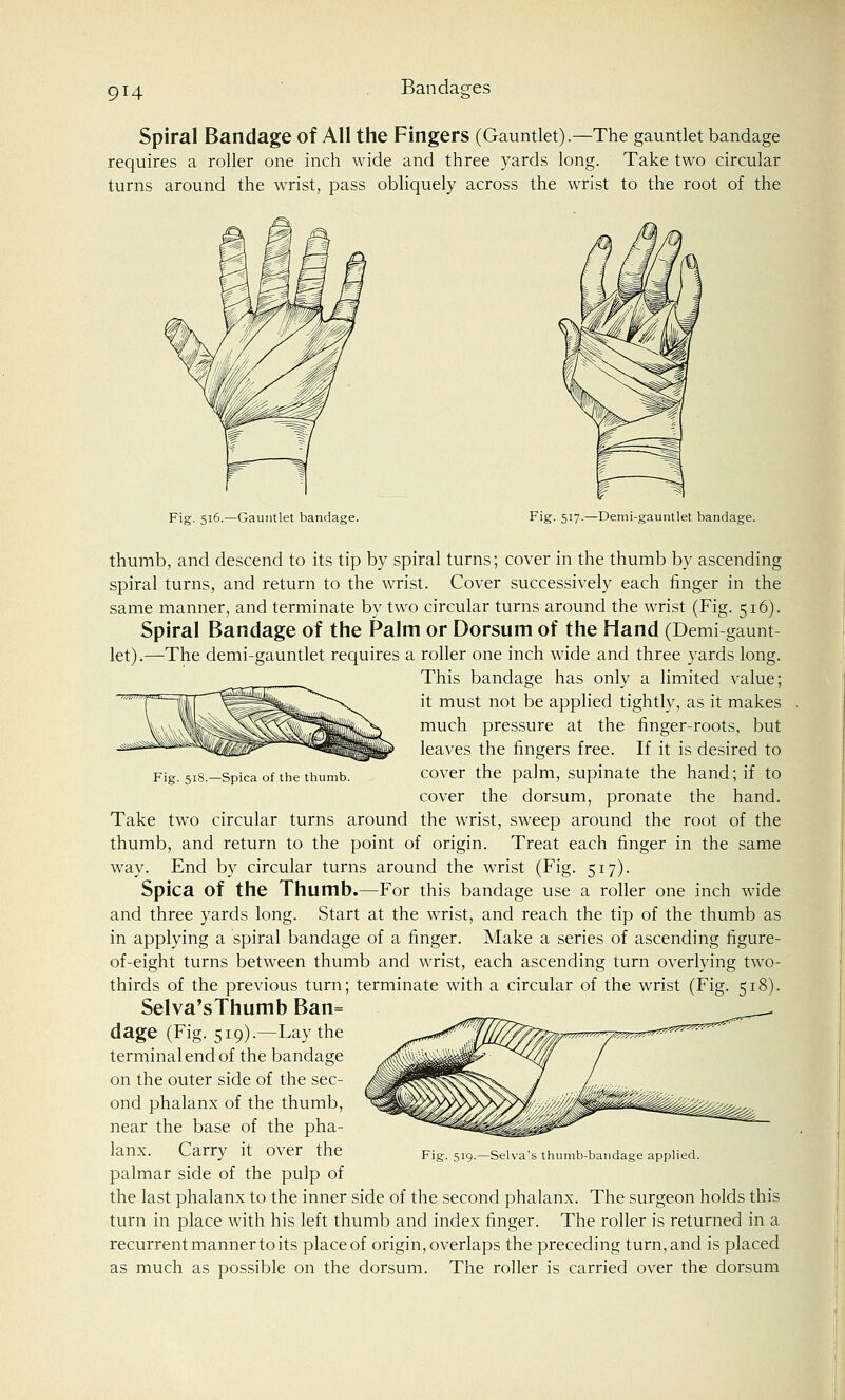 Spiral Bandage of All the Fingers (Gauntlet).—The gauntlet bandage requires a roller one inch wide and three yards long. Take two circular turns around the wrist, pass obliquely across the wrist to the root of the Fig. 516.—Gauntlet bandage. Fig. 517.—Demi-gauntlet bandage. Fig. 518.—Spica of the thumb. thumb, and descend to its tip by spiral turns; cover in the thumb by ascending spiral turns, and return to the wrist. Cover successively each finger in the same manner, and terminate by two circular turns around the wrist (Fig. 516). Spiral Bandage of the Palm or Dorsum of the Hand (Demi gaunt- let).—The demi-gauntlet requires a roller one inch wide and three yards long. This bandage has only a limited value; it must not be applied tightly, as it makes much pressure at the finger-roots, but leaves the fingers free. If it is desired to cover the palm, supinate the hand; if to cover the dorsum, pronate the hand. Take two circular turns around the wrist, sweep around the root of the thumb, and return to the point of origin. Treat each finger in the same way. End by circular turns around the wrist (Fig. 517). Spica of the Thumb.—For this bandage use a roller one inch wide and three yards long. Start at the wrist, and reach the tip of the thumb as in applying a spiral bandage of a finger. Make a series of ascending figure- of-eight turns between thumb and wrist, each ascending turn overlying two- thirds of the previous turn; terminate with a circular of the wrist (Fig. 518). Selva'sThumb Ban= dage (Fig. 519).—Lay the terminal end of the bandage on the outer side of the sec- ond phalanx of the thumb, near the base of the pha- lanx. Carry it over the palmar side of the pulp of the last phalanx to the inner side of the second phalanx. The surgeon holds this turn in place with his left thumb and index finger. The roller is returned in a recurrent manner to its place of origin, overlaps the preceding turn, and is placed as much as possible on the dorsum. The roller is carried over the dorsum Fig. 519.—Selva's thumb-bandage applied.