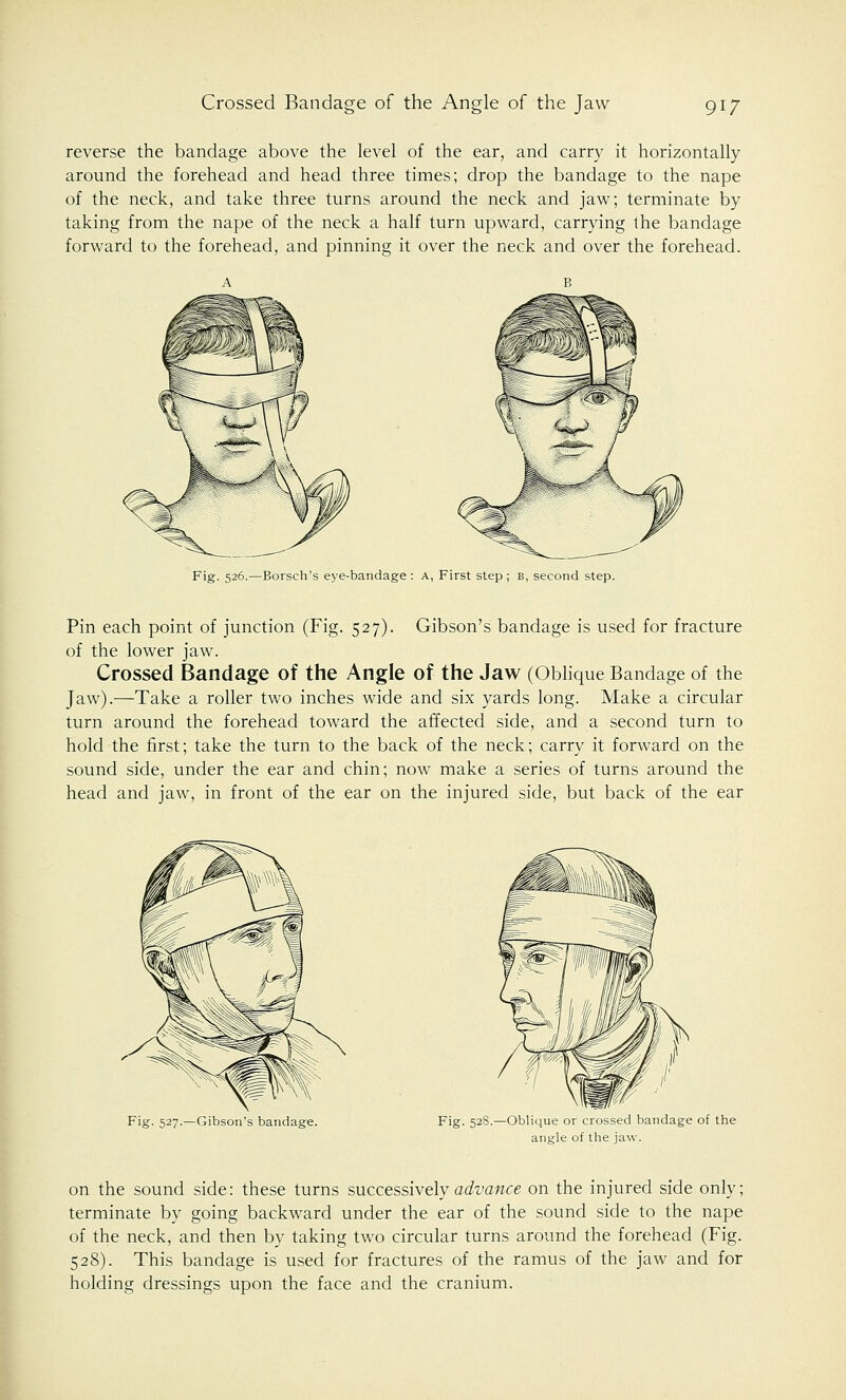 reverse the bandage above the level of the ear, and carry it horizontally around the forehead and head three times; drop the bandage to the nape of the neck, and take three turns around the neck and jaw; terminate by taking from the nape of the neck a half turn upward, carrying the bandage forward to the forehead, and pinning it over the neck and over the forehead. Fig. 526.—Borsch's eye-bandage : a, First step ; b, second step. Pin each point of junction (Fig. 527). Gibson's bandage is used for fracture of the lower jaw. Crossed Bandage of the Angle of the Jaw (Oblique Bandage of the Jaw).—Take a roller two inches wide and six yards long. Make a circular turn around the forehead toward the affected side, and a second turn to hold the first; take the turn to the back of the neck; carry it forward on the sound side, under the ear and chin; now make a series of turns around the head and jaw, in front of the ear on the injured side, but back of the ear Fig. 527.—Gibson's bandage. Fig. 528.—Oblique or crossed bandage of the angle of the jaw. on the sound side: these turns successively advance on the injured side only; terminate by going backward under the ear of the sound side to the nape of the neck, and then by taking two circular turns around the forehead (Fig. 528). This bandage is used for fractures of the ramus of the jaw and for holding dressings upon the face and the cranium.