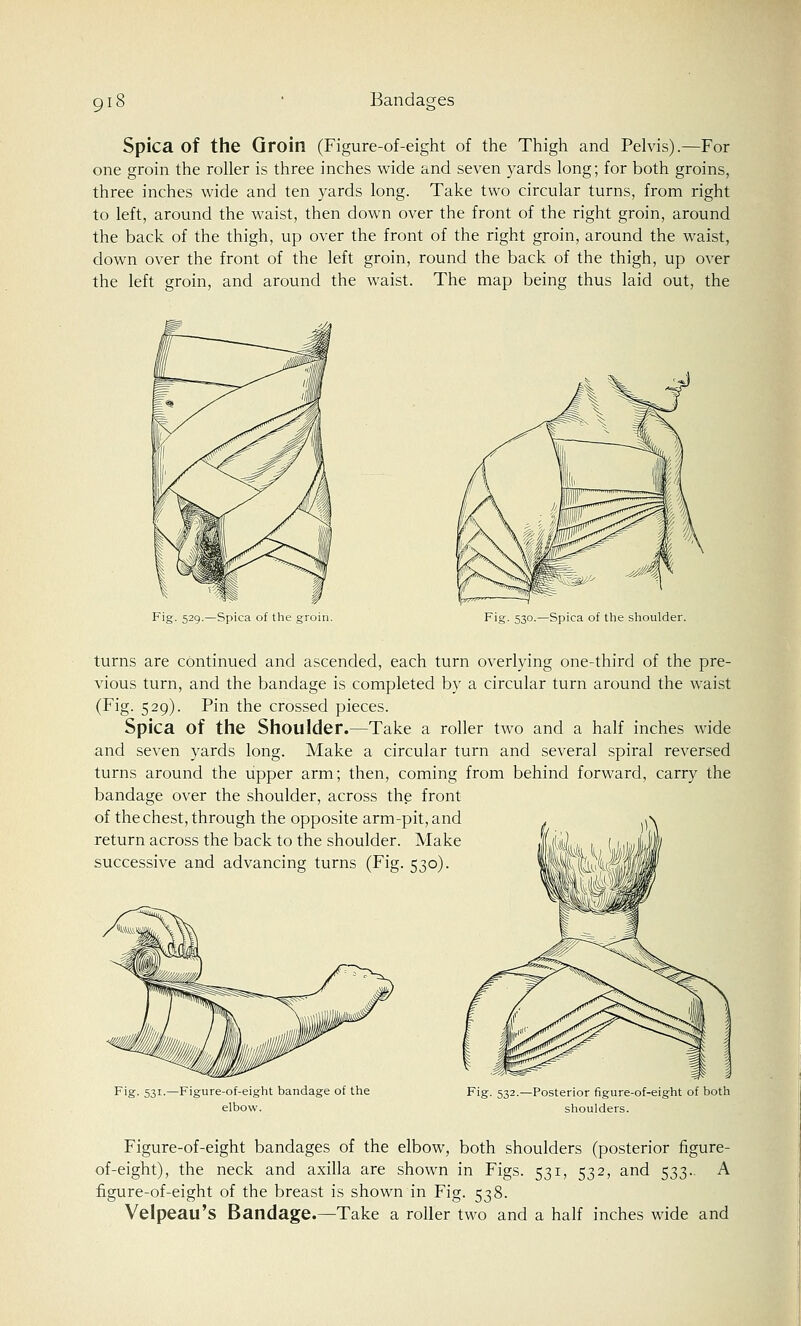 Spica of the Groin (Figure-of-eight of the Thigh and Pelvis).—For one groin the roller is three inches wide and seven yards long; for both groins, three inches wide and ten yards long. Take two circular turns, from right to left, around the waist, then down over the front of the right groin, around the back of the thigh, up over the front of the right groin, around the waist, down over the front of the left groin, round the back of the thigh, up over the left groin, and around the waist. The map being thus laid out, the 529.—Spica of the groin. Fig. 530.—Spica of the shoulder. turns are continued and ascended, each turn overlying one-third of the pre- vious turn, and the bandage is completed by a circular turn around the waist (Fig. 529). Pin the crossed pieces. Spica of the Shoulder.—Take a roller two and a half inches wide and seven yards long. Make a circular turn and several spiral reversed turns around the upper arm; then, coming from behind forward, carry the bandage over the shoulder, across the front of the chest, through the opposite arm-pit, and return across the back to the shoulder. Make HAi successive and advancing turns (Fig. 530). Fig. 531.—Figure-of-eight bandage of the elbow. Fig. 532.—Posterior figure-of-eight of both shoulders. Figure-of-eight bandages of the elbow, both shoulders (posterior figure- of-eight), the neck and axilla are shown in Figs. 531, 532, and 533.. A figure-of-eight of the breast is shown in Fig. 538. Velpeau's Bandage.—Take a roller two and a half inches wide and