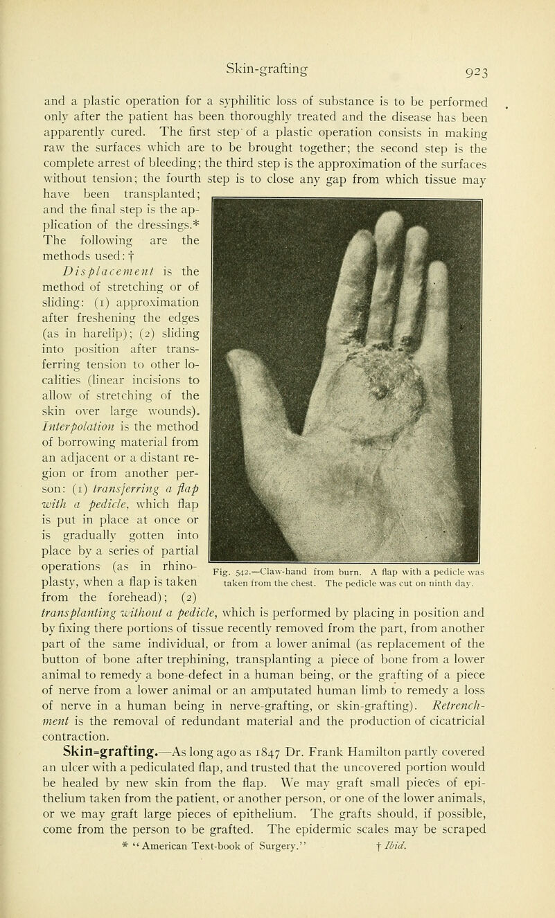 Skin-p-raftine and a plastic operation for a syphilitic loss of substance is to be performed only after the patient has been thoroughly treated and the disease has been apparently cured. The first step' of a plastic operation consists in making raw the surfaces which are to be brought together; the second step is the complete arrest of bleeding; the third step is the approximation of the surfaces without tension; the fourth step is to close any gap from which tissue may have been transplanted; and the final step is the ap- plication of the dressings.* The following are the methods used: | Displacement is the method of stretching or of sliding: (1) approximation after freshening the edges (as in harelip); (2) sliding into position after trans- ferring tension to other lo- calities (linear incisions to allow of stretching of the skin over large wounds). Interpolation is the method of borrowing material from an adjacent or a distant re- gion or from another per- son: (1) trans)erring a flap with a pedicle, which flap is put in place at once or is gradually gotten into place by a series of partial operations (as in rhino- plasty, when a flap is taken from the forehead); (2) transplanting without a pedicle, which is performed by placing in position and by fixing there portions of tissue recently removed from the part, from another part of the same individual, or from a lower animal (as replacement of the button of bone after trephining, transplanting a piece of bone from a lower animal to remedy a bone-defect in a human being, or the grafting of a piece of nerve from a lower animal or an amputated human limb to remedy a loss of nerve in a human being in nerve-grafting, or skin-grafting). Retrench- ment is the removal of redundant material and the production of cicatricial contraction. Skin=grafting.—As long ago as 1847 Dr. Frank Hamilton partly covered an ulcer with a pediculated flap, and trusted that the uncovered portion would be healed by new skin from the flap. We may graft small pieces of epi- thelium taken from the patient, or another person, or one of the lower animals, or we may graft large pieces of epithelium. The grafts should, if possible, come from the person to be grafted. The epidermic scales may be scraped * '' American Text-book of Surgery.'' f Ibid. Fig. 542.—Claw-hanc taken from the chest. 3m burn. A flap with a pedicle was The pedicle was cut on ninth day.