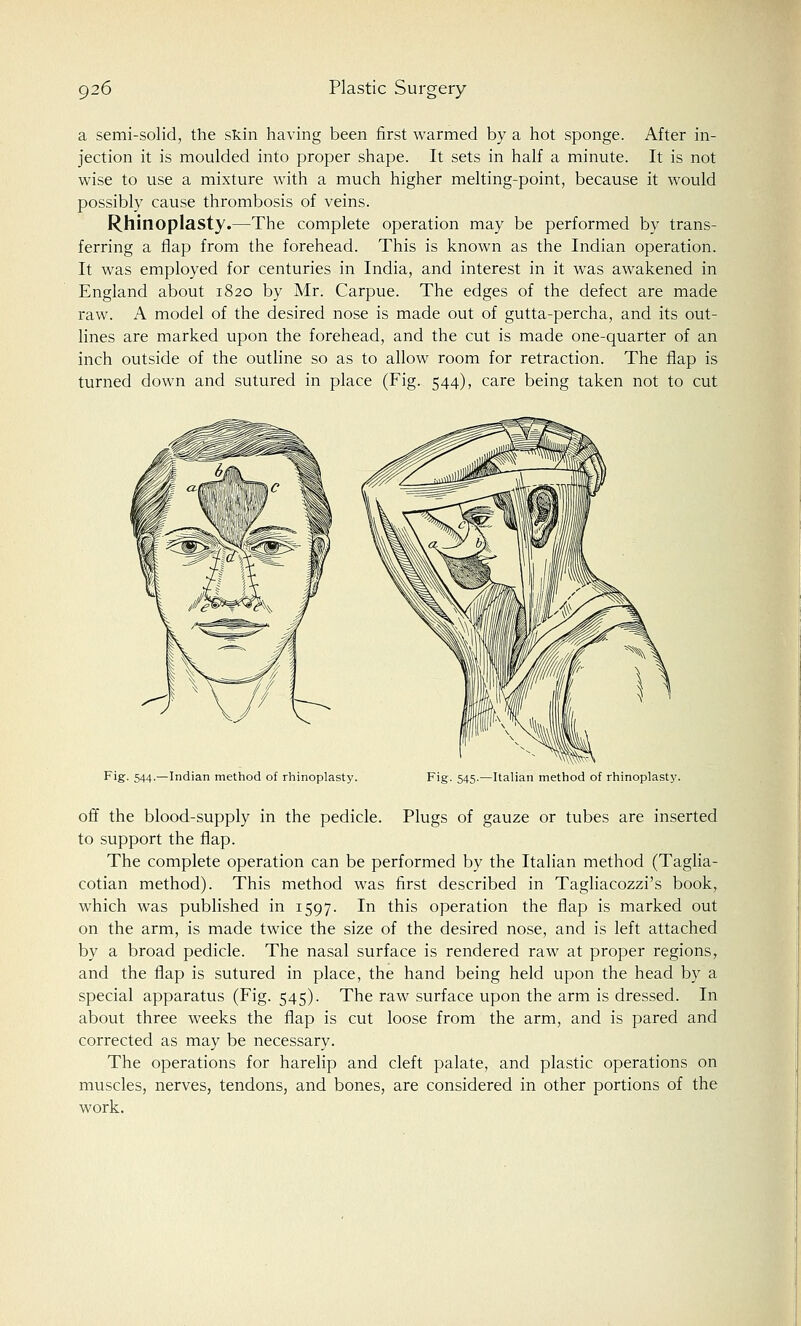 a semi-solid, the skin having been first warmed by a hot sponge. After in- jection it is moulded into proper shape. It sets in half a minute. It is not wise to use a mixture with a much higher melting-point, because it would possibly cause thrombosis of veins. Rhinoplasty.—The complete operation may be performed by trans- ferring a flap from the forehead. This is known as the Indian operation. It was employed for centuries in India, and interest in it was awakened in England about 1820 by Mr. Carpue. The edges of the defect are made raw. A model of the desired nose is made out of gutta-percha, and its out- lines are marked upon the forehead, and the cut is made one-quarter of an inch outside of the outline so as to allow room for retraction. The flap is turned down and sutured in place (Fig. 544), care being taken not to cut Fig. 544.—Indian method of rhinoplasty. Fig. 545.—Italian method of rhinoplasty. off the blood-supply in the pedicle. Plugs of gauze or tubes are inserted to support the flap. The complete operation can be performed by the Italian method (Taglia- cotian method). This method was first described in Tagliacozzi's book, which was published in 1597. In this operation the flap is marked out on the arm, is made twice the size of the desired nose, and is left attached by a broad pedicle. The nasal surface is rendered raw at proper regions, and the flap is sutured in place, the hand being held upon the head by a special apparatus (Fig. 545). The raw surface upon the arm is dressed. In about three weeks the flap is cut loose from the arm, and is pared and corrected as may be necessary. The operations for harelip and cleft palate, and plastic operations on muscles, nerves, tendons, and bones, are considered in other portions of the work.