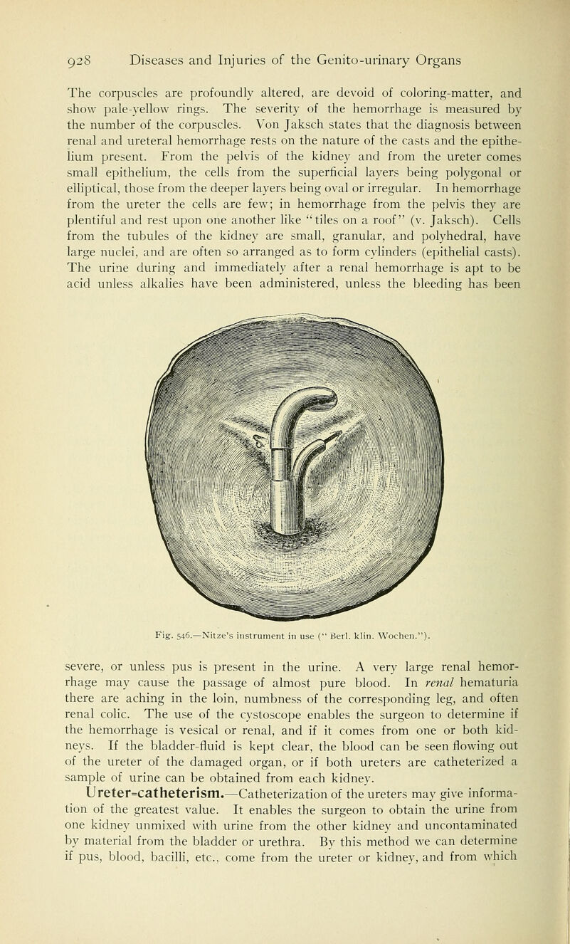 The corpuscles are profoundly altered, are devoid of coloring-matter, and show pale-yellow rings. The severity of the hemorrhage is measured by the number of the corpuscles. Von Jaksch states that the diagnosis between renal and ureteral hemorrhage rests on the nature of the casts and the epithe- lium present. From the pelvis of the kidney and from the ureter comes small epithelium, the cells from the superficial layers being polygonal or elliptical, those from the deeper layers being oval or irregular. In hemorrhage from the ureter the cells are few; in hemorrhage from the pelvis they are plentiful and rest upon one another like tiles on a roof (v. Jaksch). Cells from the tubules of the kidney are small, granular, and polyhedral, have large nuclei, and are often so arranged as to form cylinders (epithelial casts). The urine during and immediately after a renal hemorrhage is apt to be acid unless alkalies have been administered, unless the bleeding has been Fig. 546.—Nitze's instrument in use ( Berl. klin. Wochen.). severe, or unless pus is present in the urine. A very large renal hemor- rhage may cause the passage of almost pure blood. In renal hematuria there are aching in the loin, numbness of the corresponding leg, and often renal colic. The use of the cystoscope enables the surgeon to determine if the hemorrhage is vesical or renal, and if it comes from one or both kid- neys. If the bladder-fluid is kept clear, the blood can be seen flowing out of the ureter of the damaged organ, or if both ureters are catheterized a sample of urine can be obtained from each kidney. Ureter=catheterism.—Catheterization of the ureters may give informa- tion of the greatest value. It enables the surgeon to obtain the urine from one kidney unmixed with urine from the other kidney and uncontaminated by material from the bladder or urethra. By this method we can determine if pus, blood, bacilli, etc., come from the ureter or kidney, and from which
