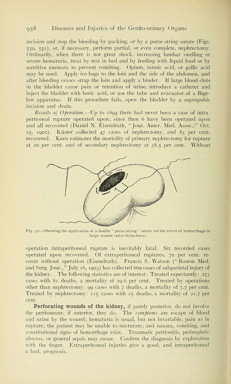 incision and stop the bleeding by packing, or by a purse-string suture (Figs. 550, 551), or, if necessary, perform partial, or even complete, nephrectomy. Ordinarily, when there is not great shock, increasing lumbar swelling or severe hematuria, treat by rest in bed and by feeding with liquid food or by nutritive enemata to prevent vomiting. Opium, tannic acid, or gallic acid may be used. Apply ice-bags to the loin and the side of the abdomen, and after bleeding ceases strap the loin and apply a binder. If large blood-clots in the bladder cause pain or retention of urine, introduce a catheter and inject the bladder with boric acid, or use the tube and evacuator of a Bige- low apparatus. If this procedure fails, open the bladder by a suprapubic incision and drain. Results of Operation.—Up to 1894 there had never been a case of intra- peritoneal rupture operated upon; since then 6 have been operated upon and all recovered (Daniel N. Eisendrath, Jour. Amer. Med. Assoc, Oct. 25, 1902). Kuster collected 47 cases of nephrectomy, and 83 per cent, recovered. Keen estimates the mortality of primary nephrectomy for rupture at 20 per cent, and of secondary nephrectomy at 38.5 per cent. Without Fig. 551.—Showing the application of a double  purse-string  suture for the arrest of hemorrhage in large wound (after Schachner). operation intraperitoneal rupture is inevitably fatal. Six recorded cases operated upon recovered. Of extraperitoneal ruptures, 70 per cent, re- cover without operation (Eisendrath). Francis S. Watson (Boston Med. and Surg. Jour., July 16, 1903) has collected 660 cases of subparietal injury of the kidney. The following statistics are of interest: Treated expectantly: 273 cases with 81 deaths, a mortality of 29.6 per cent. Treated by operations other than nephrectomy: 99 cases with 7 deaths, a mortality of 7.7 per cent. Treated by nephrectomy: 115 cases with 25 deaths, a mortality of 21.7 per cent. Perforating wounds of the kidney, if purely posterior, do not involve the peritoneum; if anterior, they do. The symptoms are escape of blood and urine by the wound; hematuria is usual, but not invariable; pain as in rupture; the patient may be unable to micturate; and nausea, vomiting, and constitutional signs of hemorrhage exist. Traumatic peritonitis, perinephric abscess, or general sepsis may ensue. Confirm the diagnosis by exploration with the finger. Extraperitoneal injuries give a good, and intraperitoneal a bad, prognosis.
