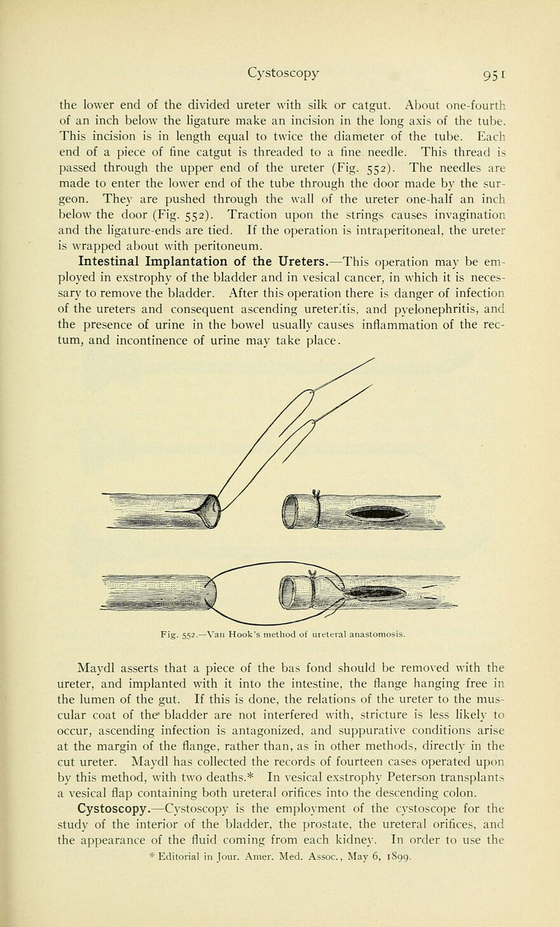 the lower end of the divided ureter with silk or catgut. About one-fourth of an inch below the ligature make an incision in the long axis of the tube. This incision is in length equal to twice the diameter of the tube. Each end of a piece of fine catgut is threaded to a fine needle. This thread is passed through the upper end of the ureter (Fig. 552). The needles are made to enter the lower end of the tube through the door made by the sur- geon. They are pushed through the wall of the ureter one-half an inch below the door (Fig. 552). Traction upon the strings causes invagination and the ligature-ends are tied. If the operation is intraperitoneal, the ureter is wrapped about with peritoneum. Intestinal Implantation of the Ureters.—This operation may be em- ployed in exstrophy of the bladder and in vesical cancer, in which it is neces- sary to remove the bladder. After this operation there is danger of infection of the ureters and consequent ascending ureteritis, and pyelonephritis, and the presence of urine in the bowel usually causes inflammation of the rec- tum, and incontinence of urine may take place. 552.—Van Hook's method of ureteral anastomosis. Maydl asserts that a piece of the bas fond should be removed with the ureter, and implanted with it into the intestine, the flange hanging free in the lumen of the gut. If this is done, the relations of the ureter to the mus- cular coat of the' bladder are not interfered with, stricture is less likely to occur, ascending infection is antagonized, and suppurative conditions arise at the margin of the flange, rather than, as in other methods, directly in the cut ureter. Maydl has collected the records of fourteen cases operated upon by this method, with two deaths.* In vesical exstrophy Peterson transplants a vesical flap containing both ureteral orifices into the descending colon. Cystoscopy.—Cystoscopy is the employment of the cystoscope for the study of the interior of the bladder, the prostate, the ureteral orifices, and the appearance of the fluid coming from each kidney. In order to use the * Editorial in Jour. Amer. Med. Assoc, May 6, 1899.